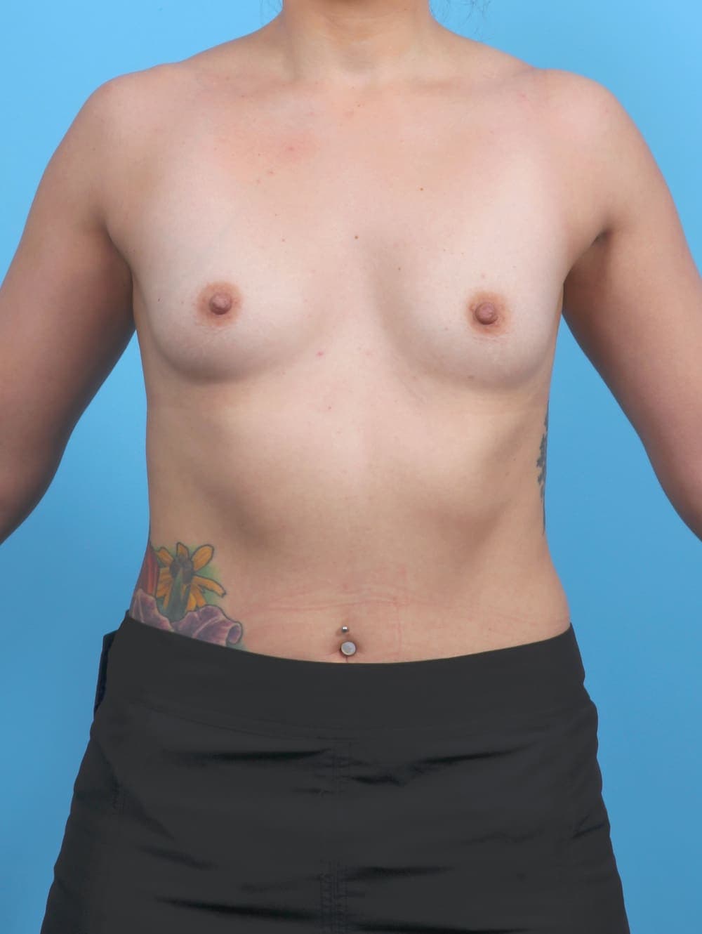 Breast Augmentation case #6010 before
