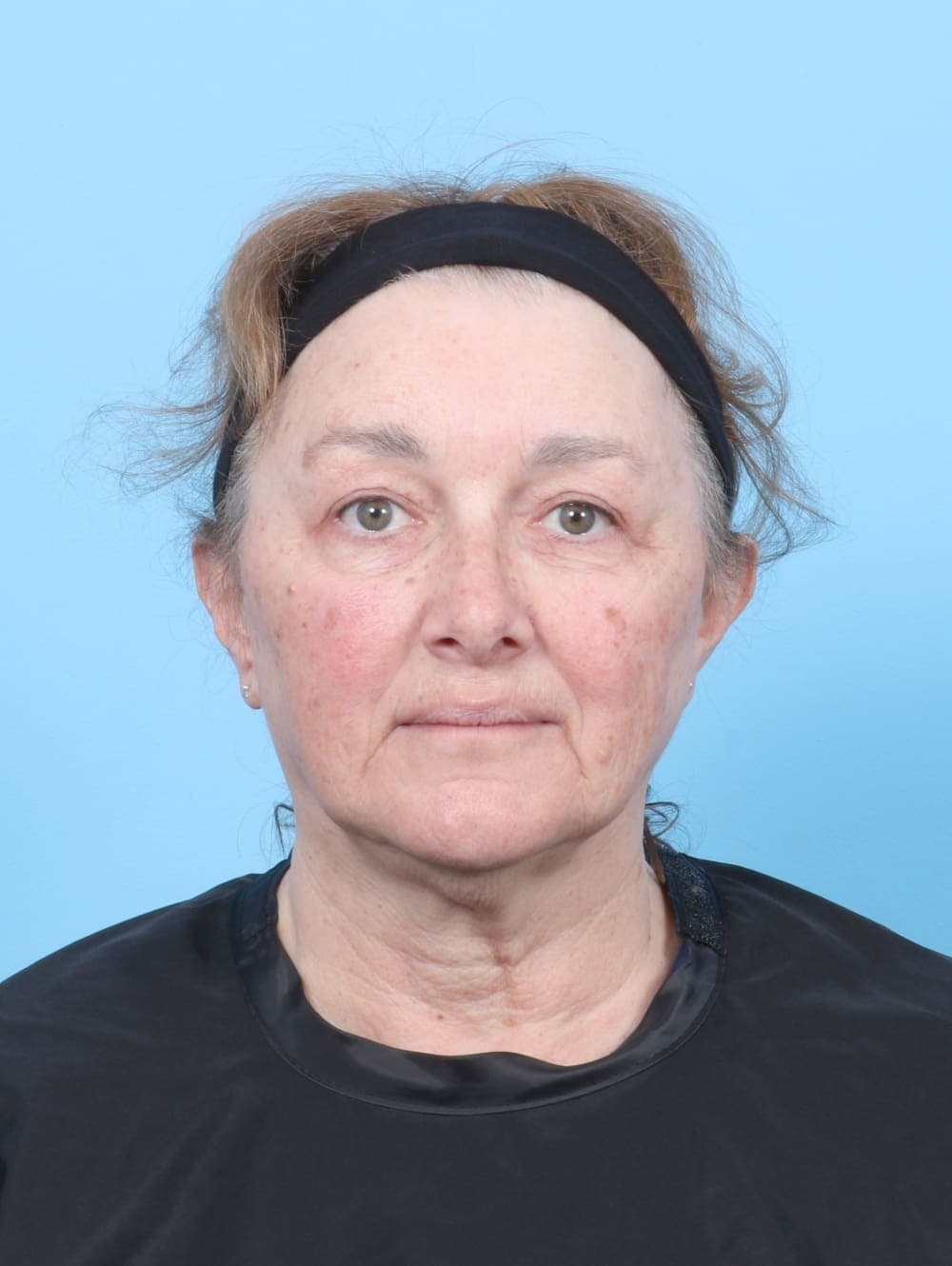Facial Surgery case #6751 after