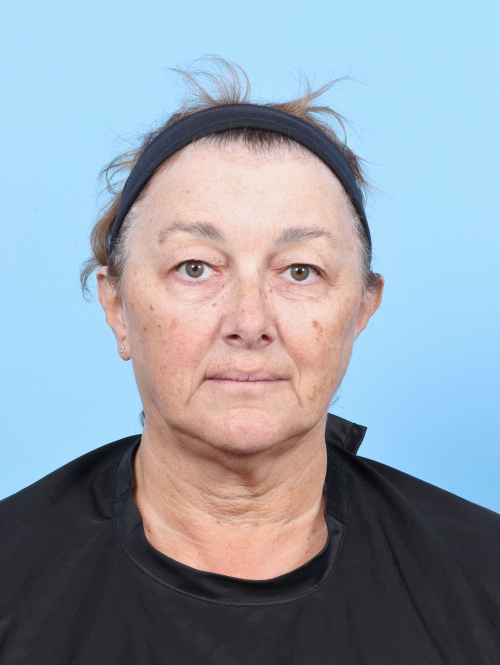 Facial Surgery case #6751 before