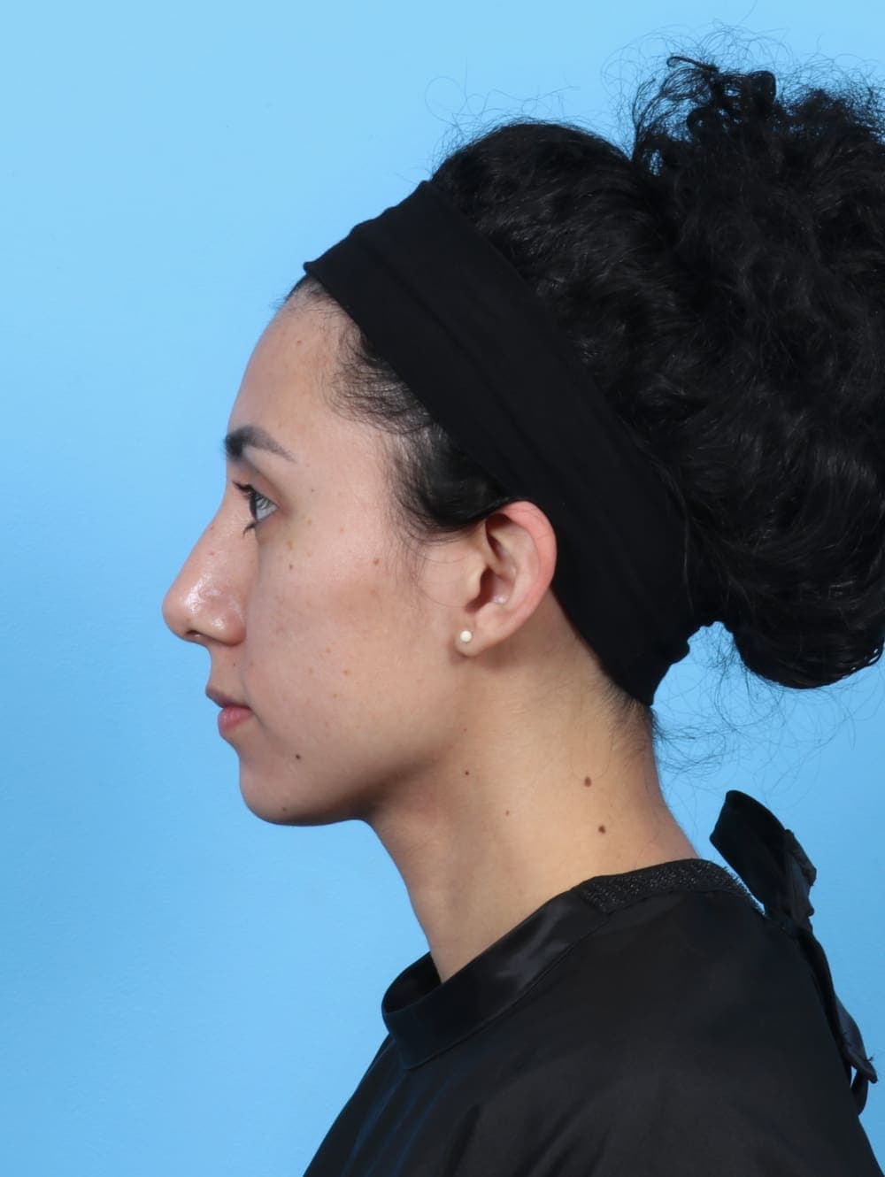 Facial Surgery case #6237 after