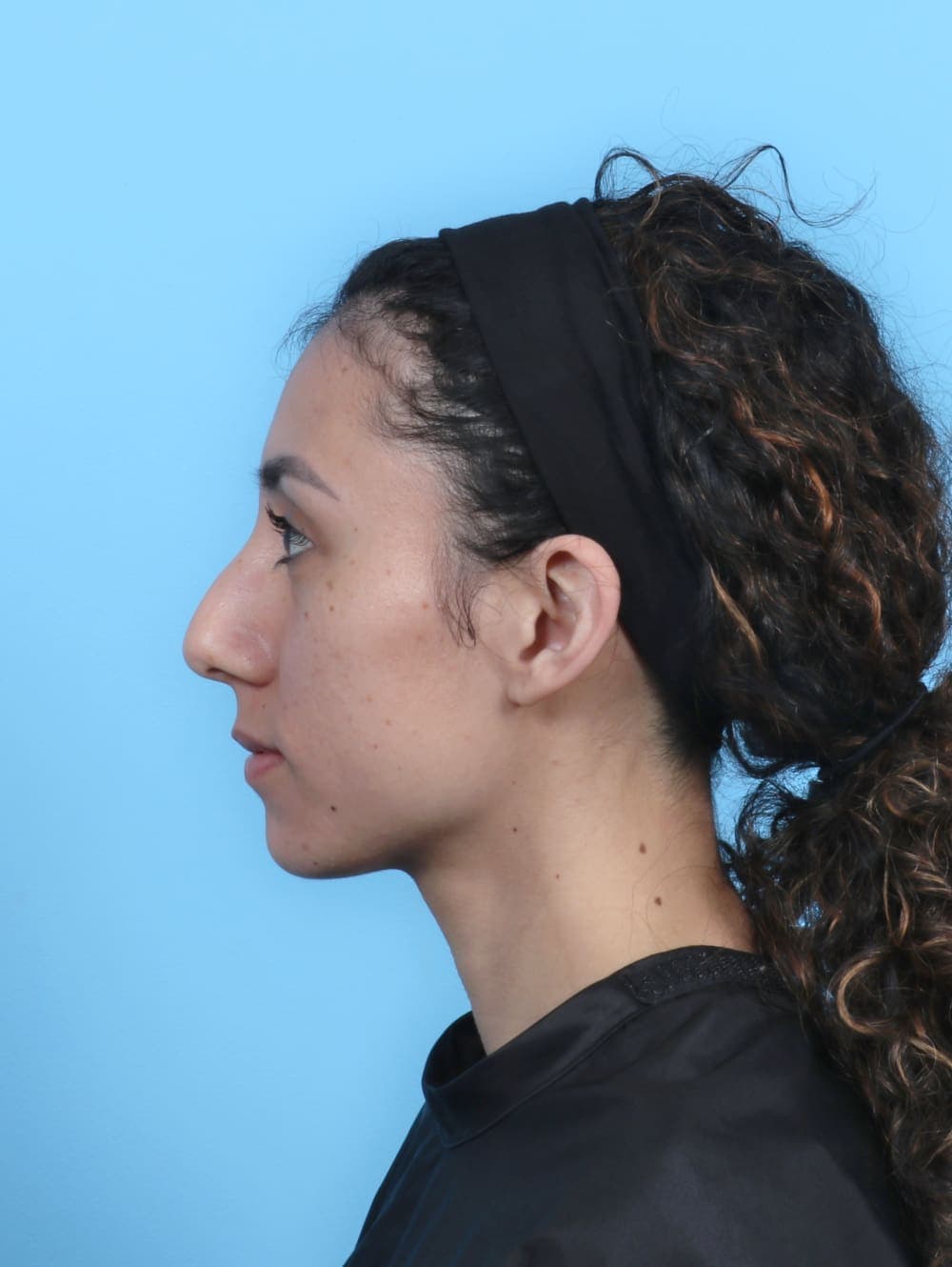 Facial Surgery case #6237 before