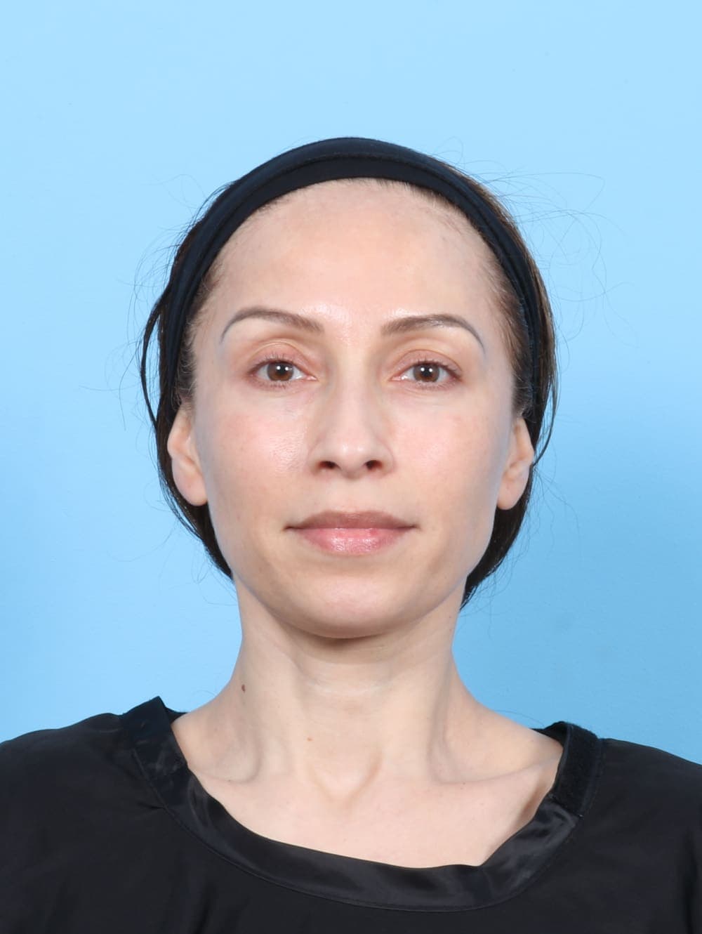 Facial Surgery case #6685 after