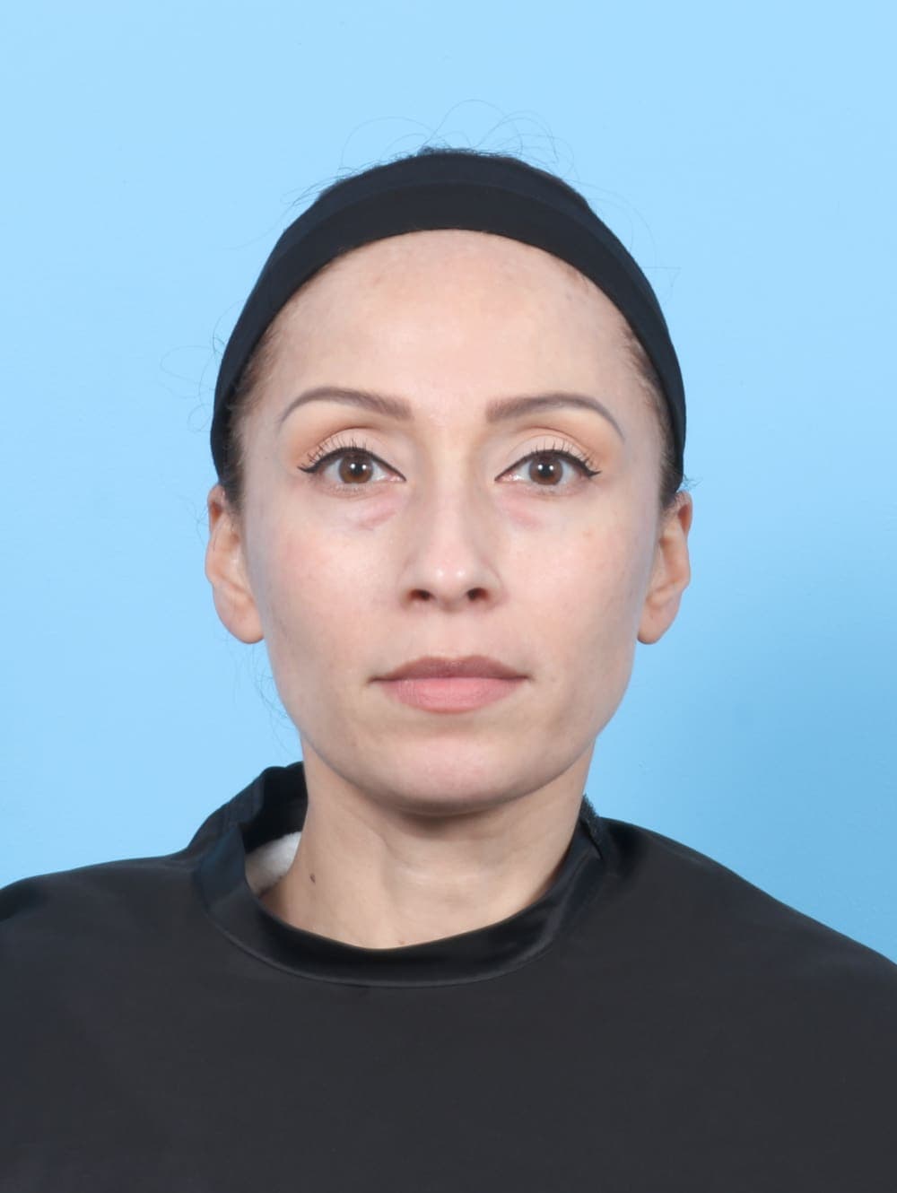 Facial Surgery case #6685 before