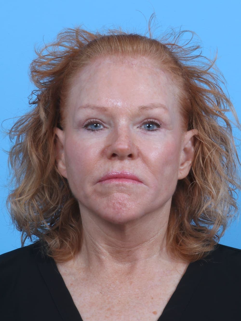 Facial Surgery case #3925 after