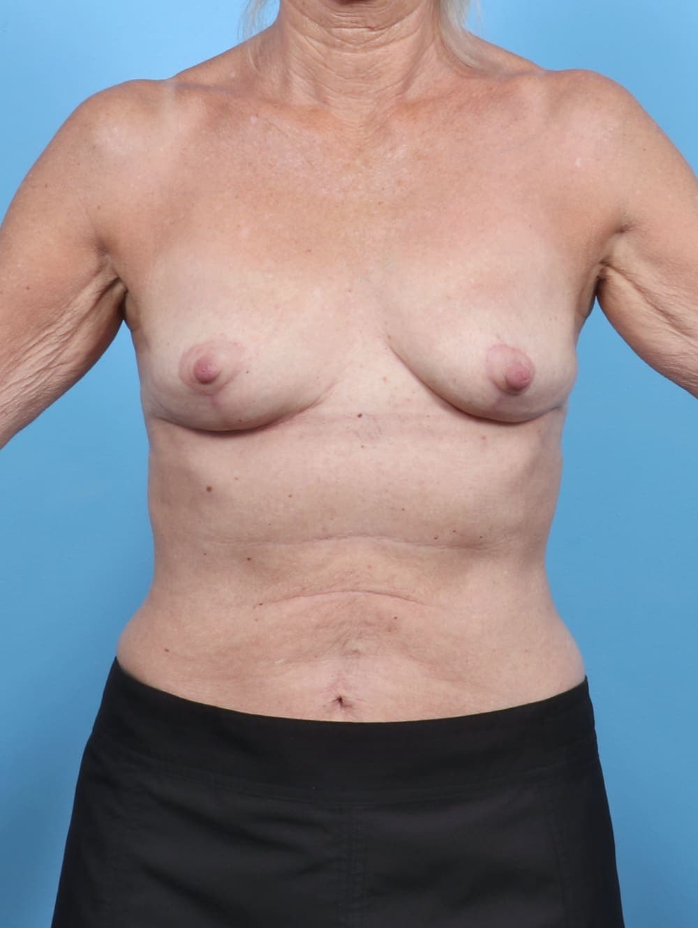Breast Implant Removal with Lift case #5367 after, image 1