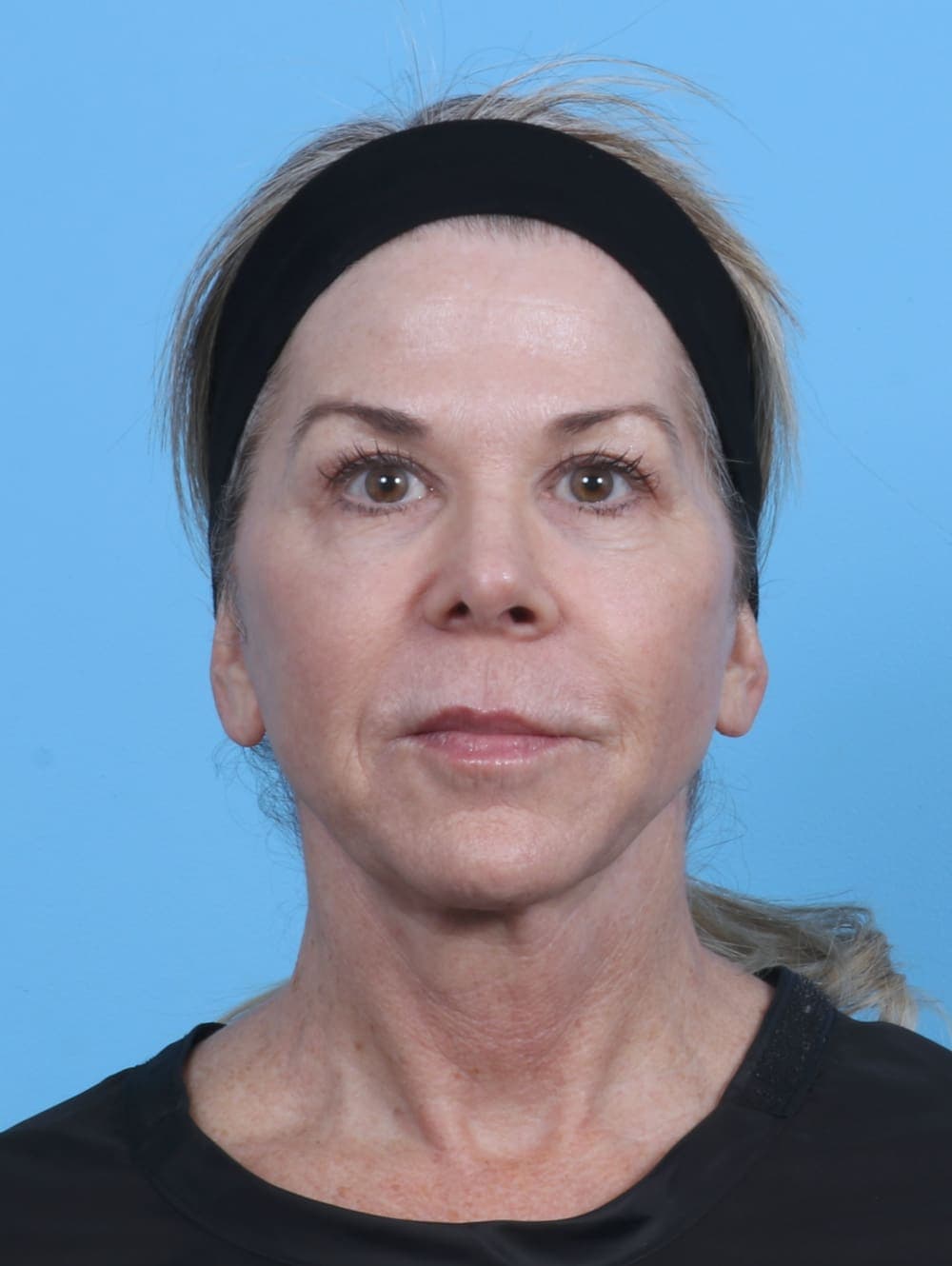Facial Surgery case #4211 after