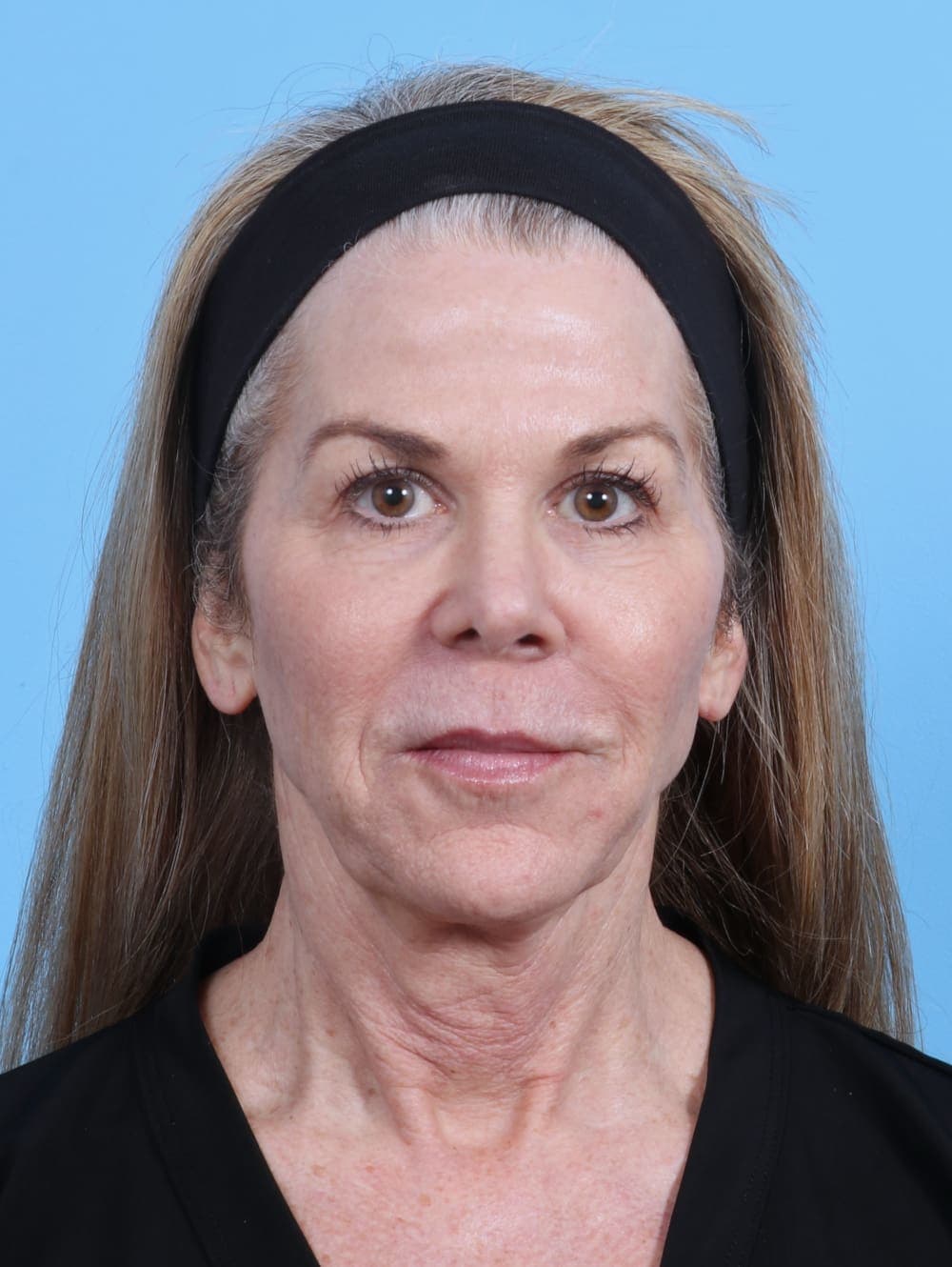 Facial Surgery case #4211 before