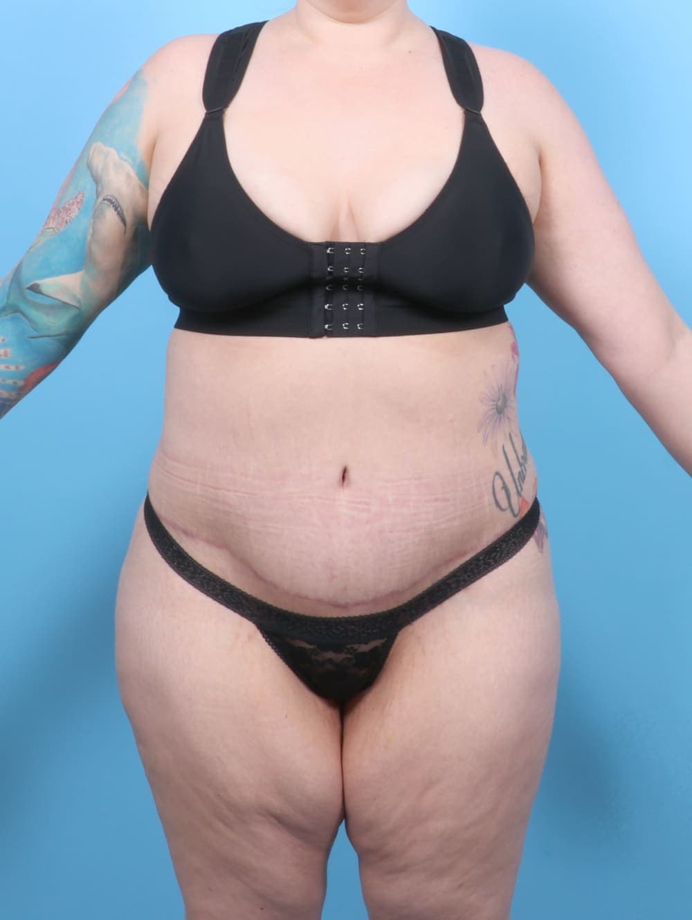 Tummy Tuck case #6565 after