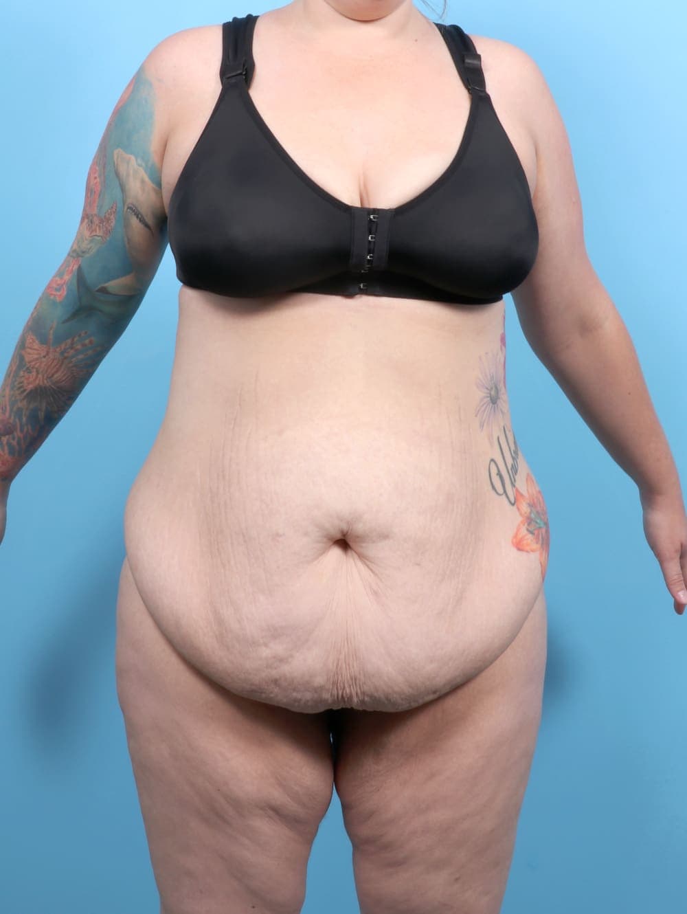 Tummy Tuck case #6565 before