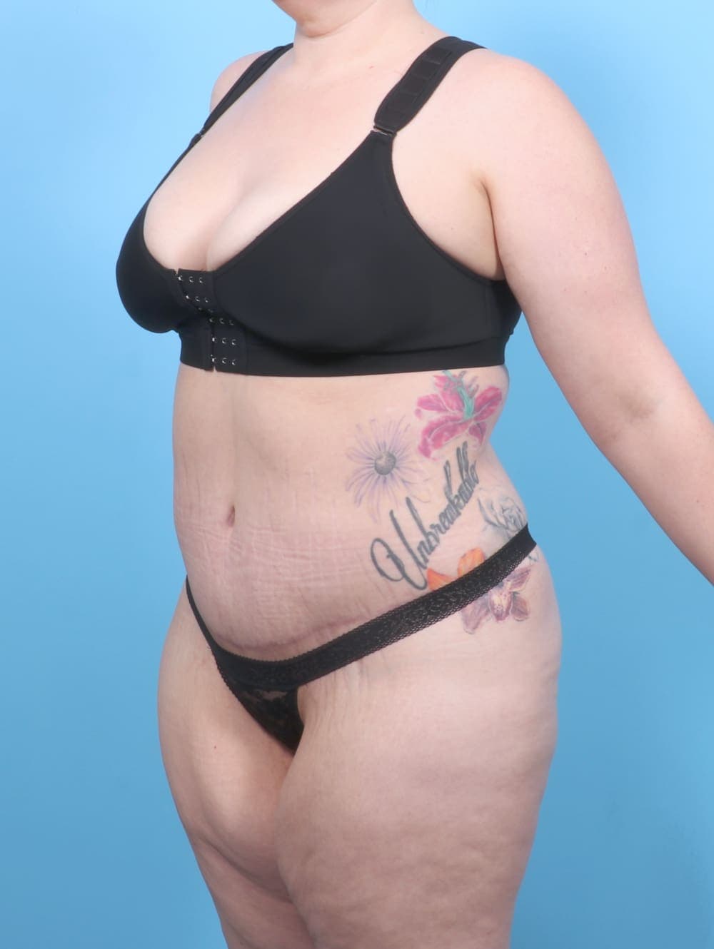 Tummy Tuck case #6565 after, image 2