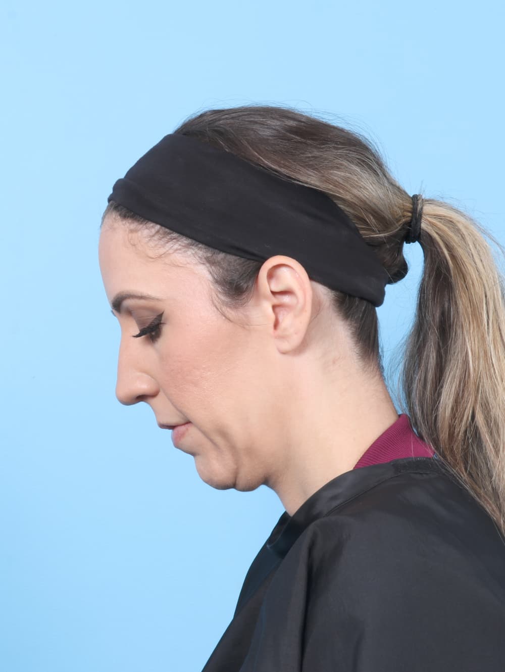Facelift case #8766 before, image 3