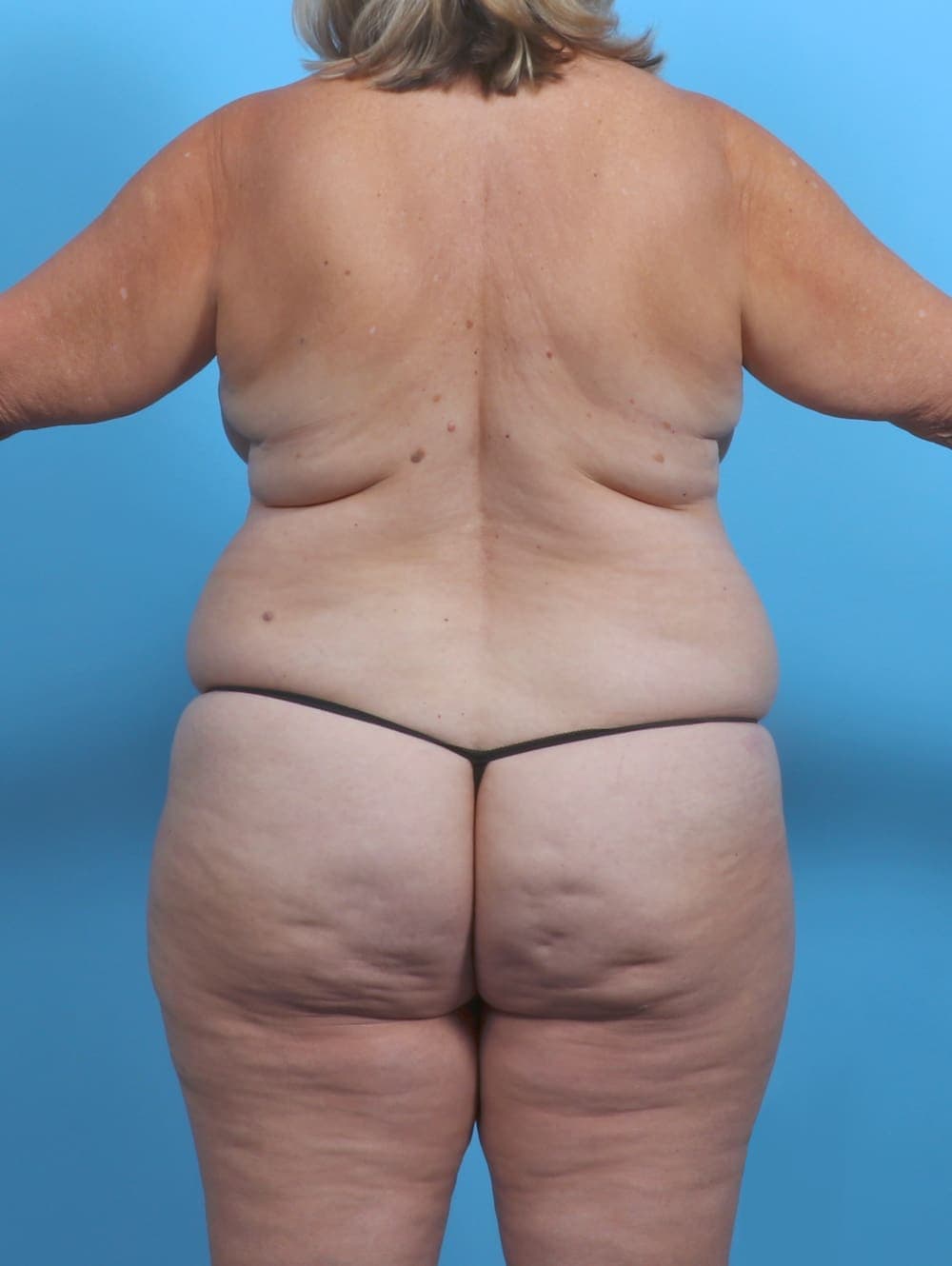 Mommy Makeover case #5265 before, image 2