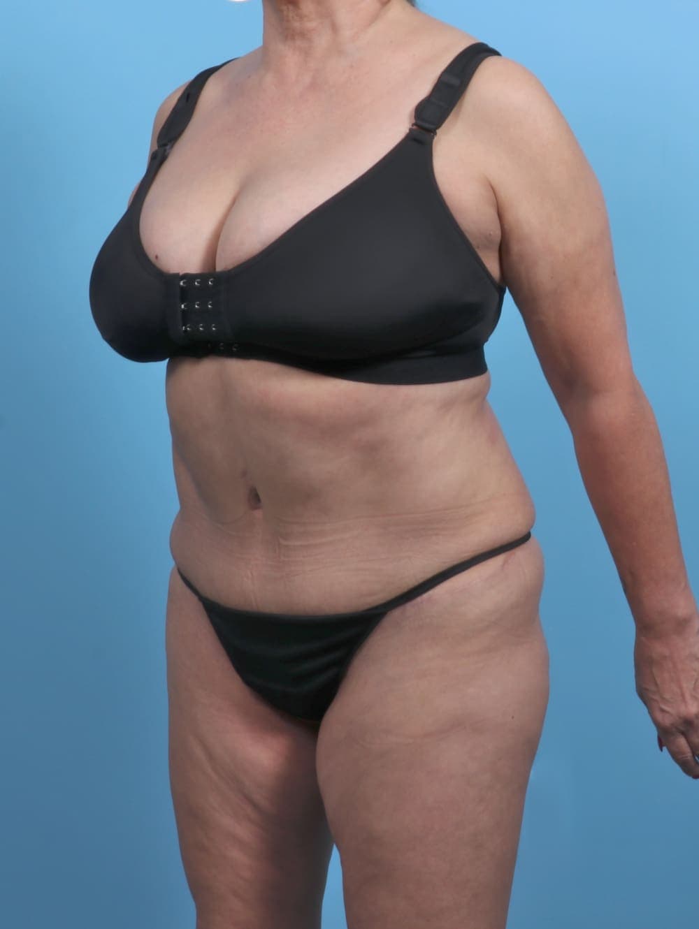 Tummy Tuck case #4489 after, image 3