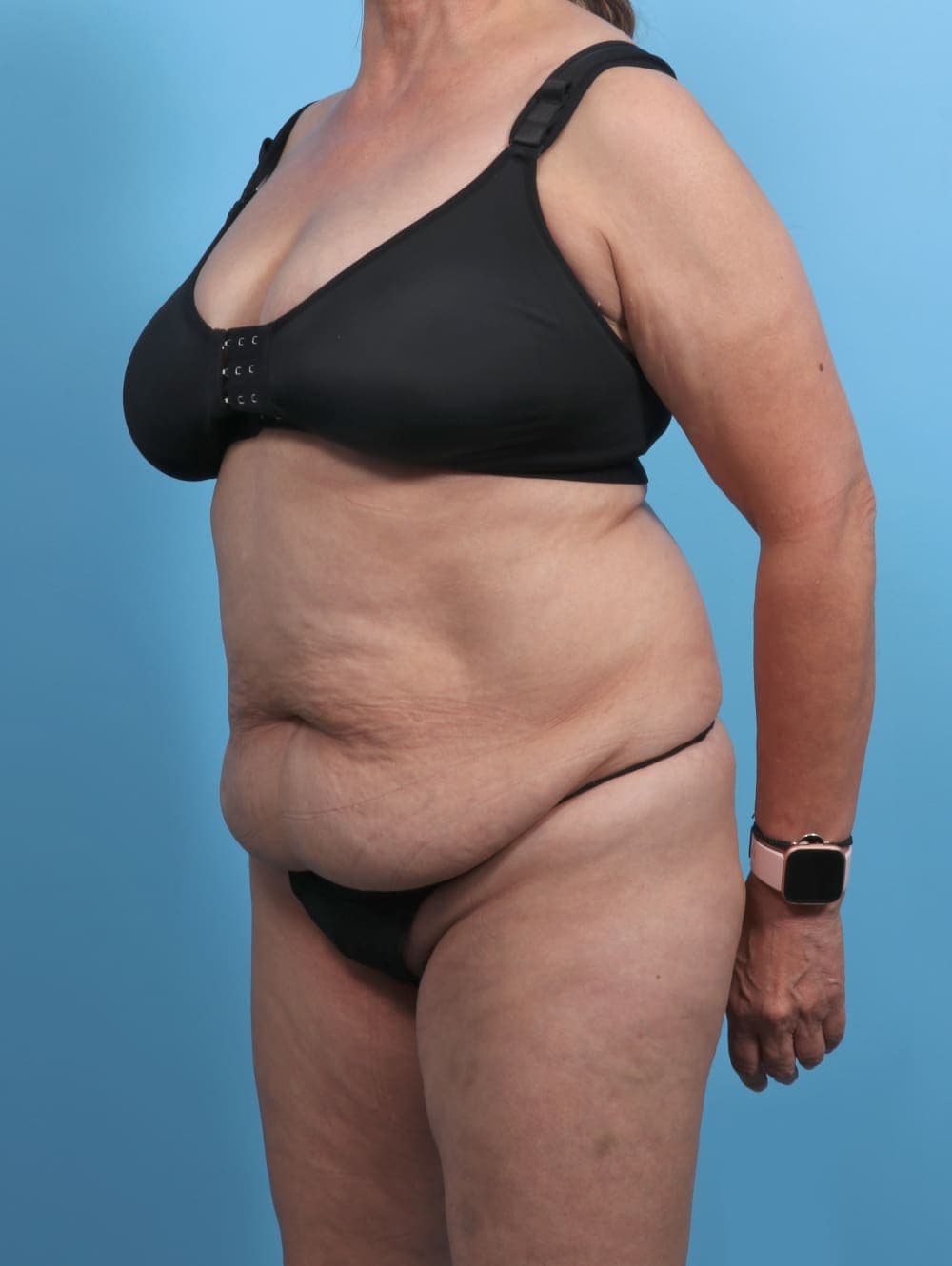 Tummy Tuck case #4489 before, image 3