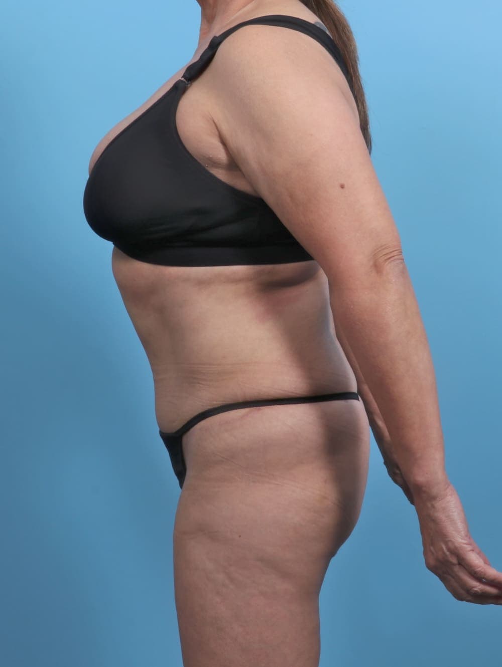 Tummy Tuck case #4489 after, image 4