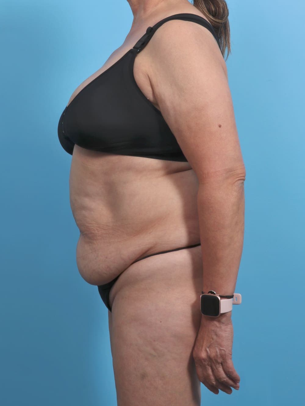 Tummy Tuck case #4489 before, image 4