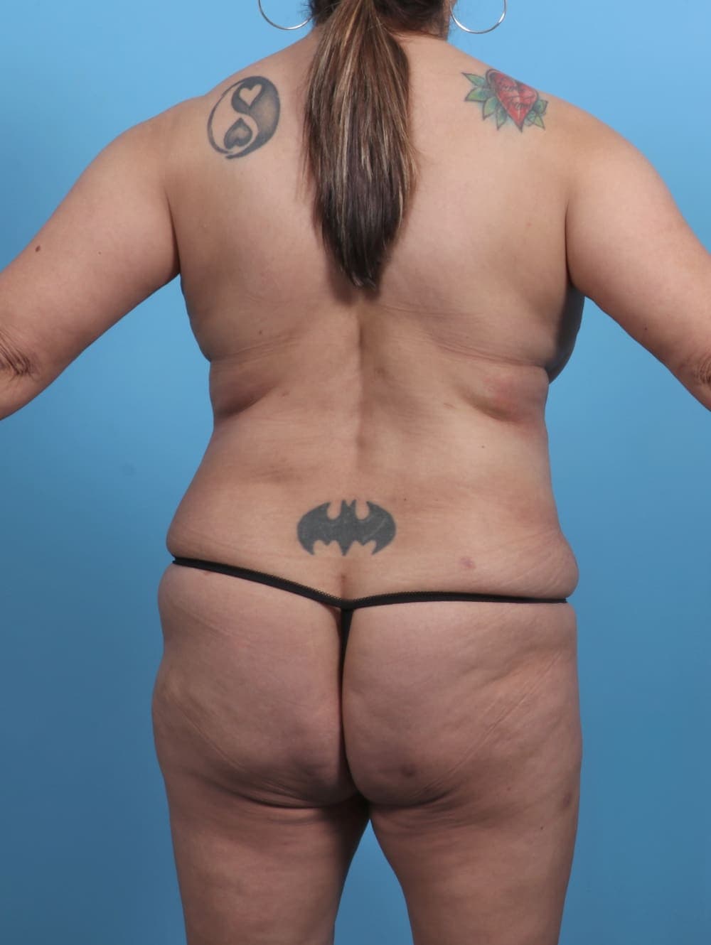 Tummy Tuck case #4489 after, image 2