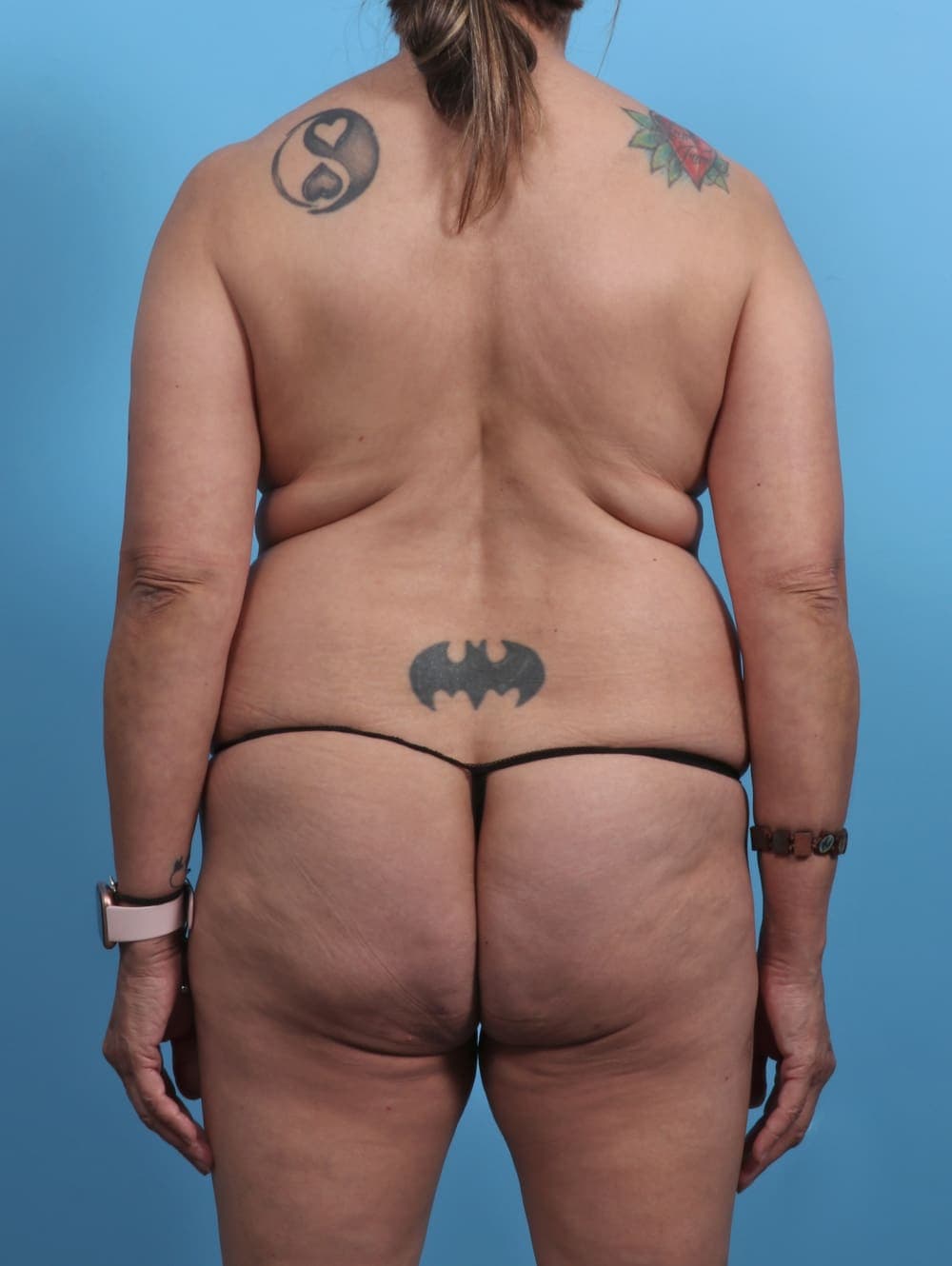 Tummy Tuck case #4489 before, image 2