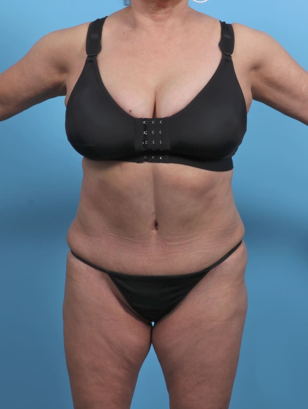 Liposuction case #4489 after