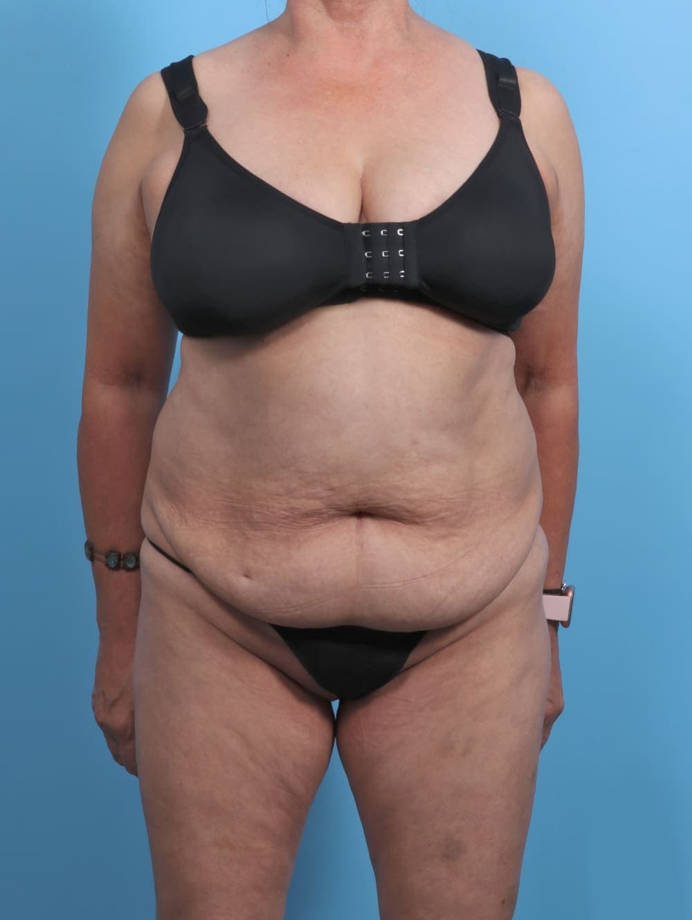Liposuction case #4489 before