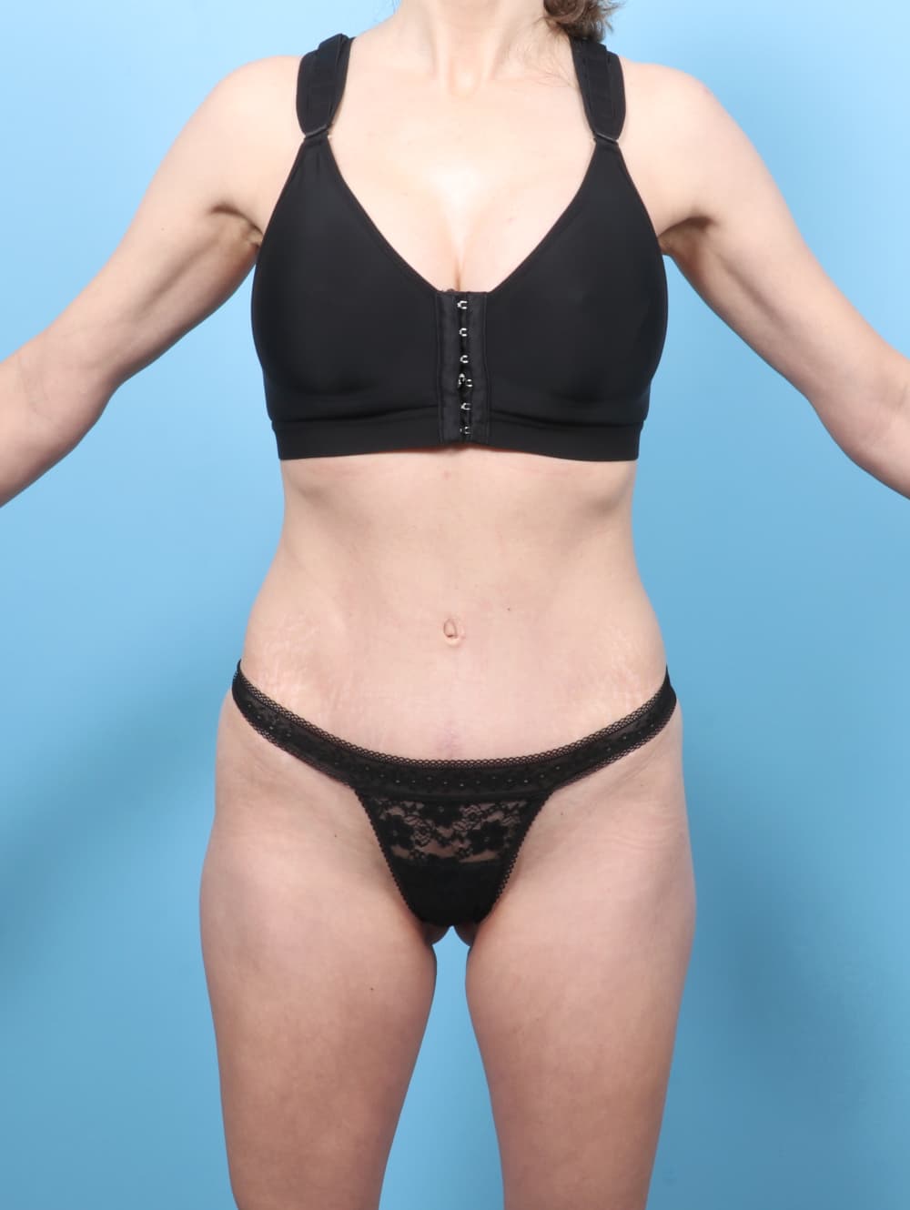Tummy Tuck case #8650 after, image 1