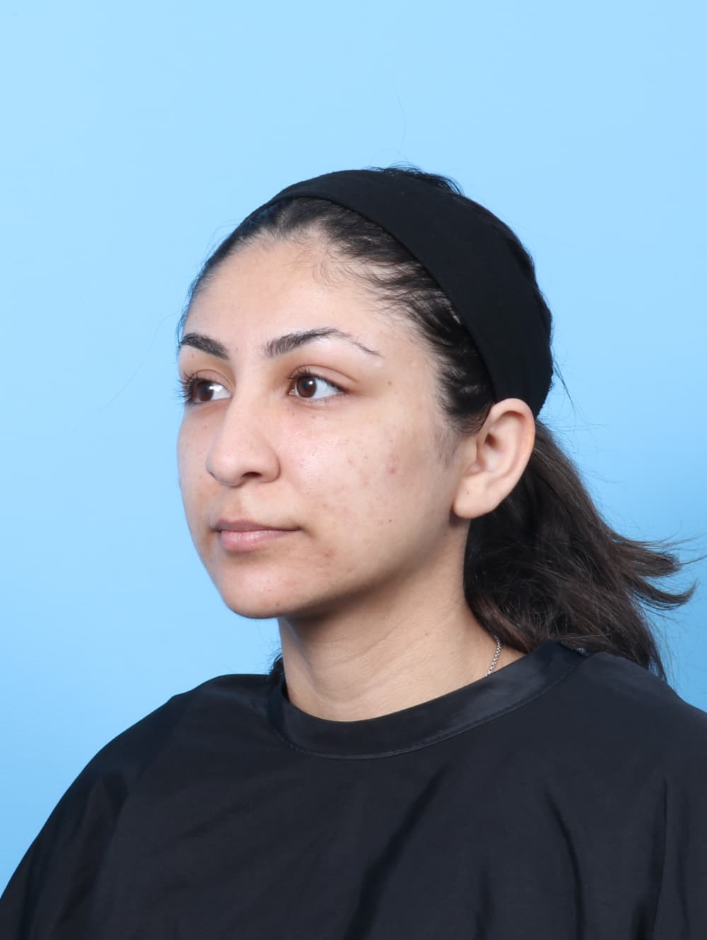Rhinoplasty case #8776 before, image 3