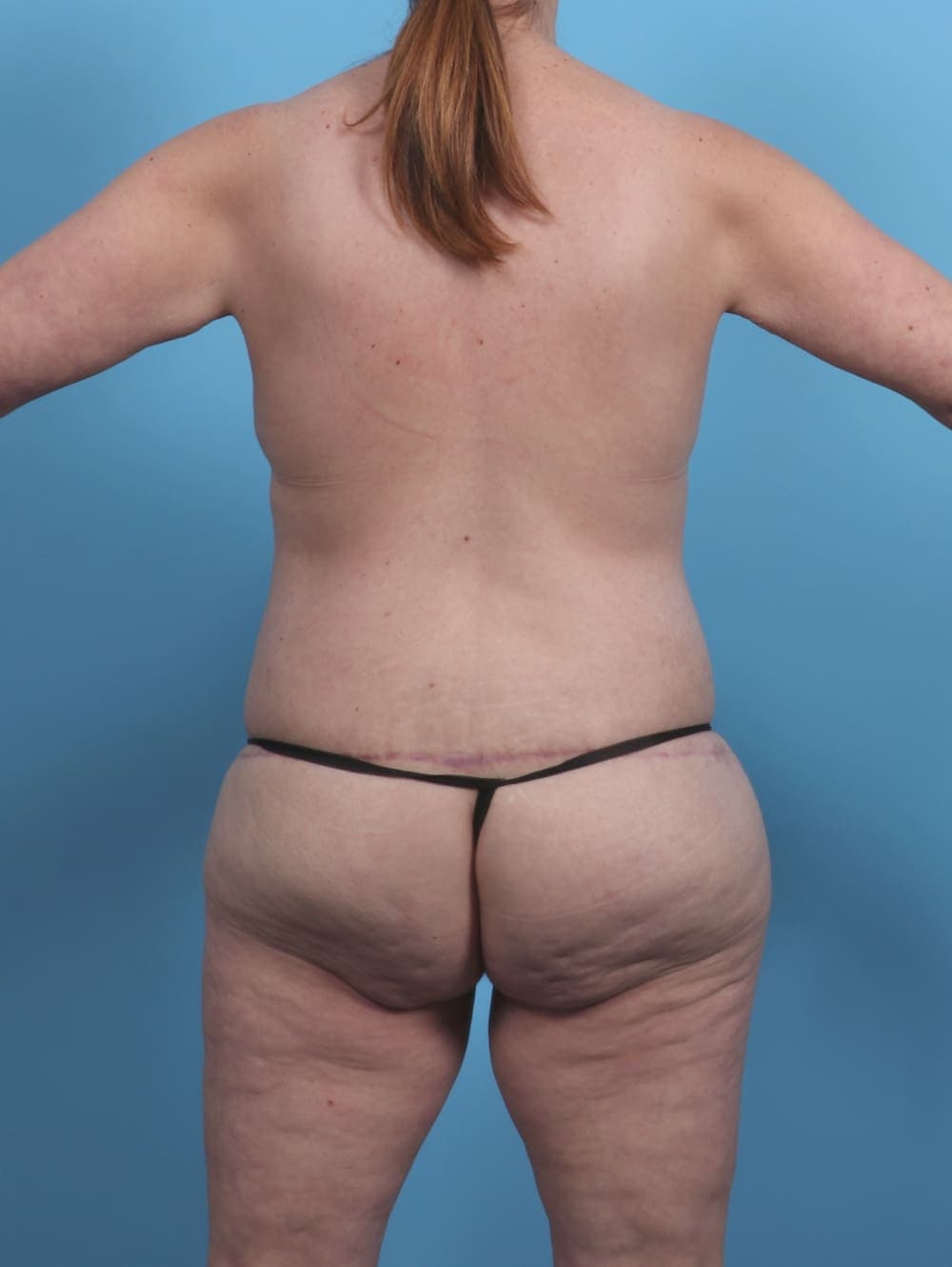 Breast Lift/Reduction case #4523 after, image 2