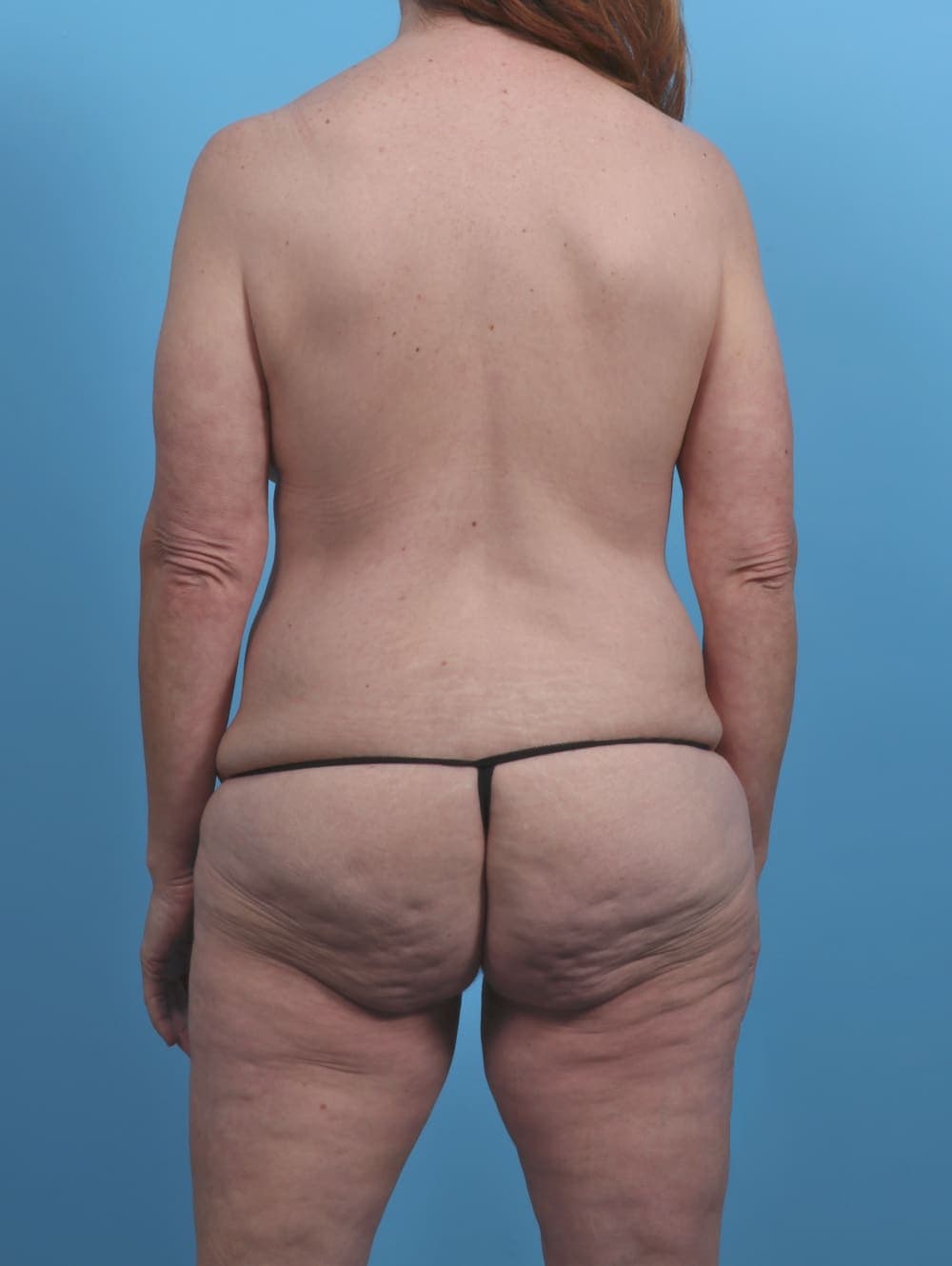 Breast Lift/Reduction case #4523 before, image 2