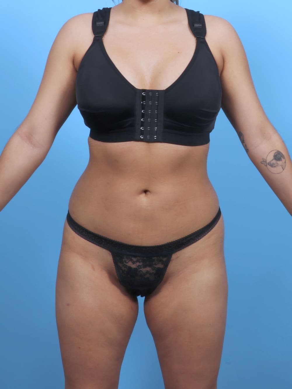 Liposuction case #5976 after