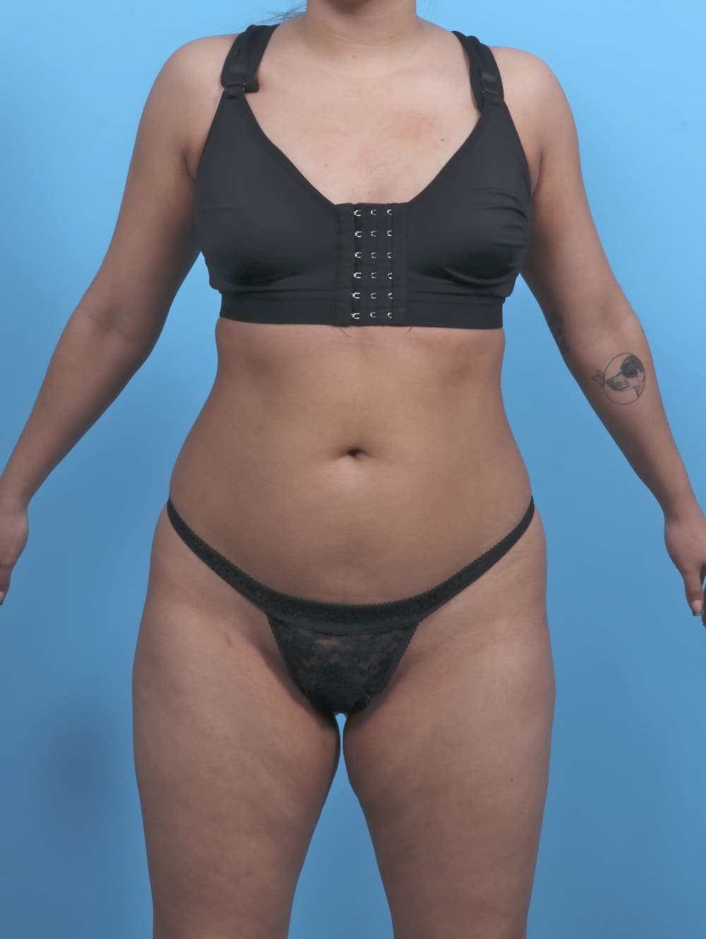 Liposuction case #5976 before
