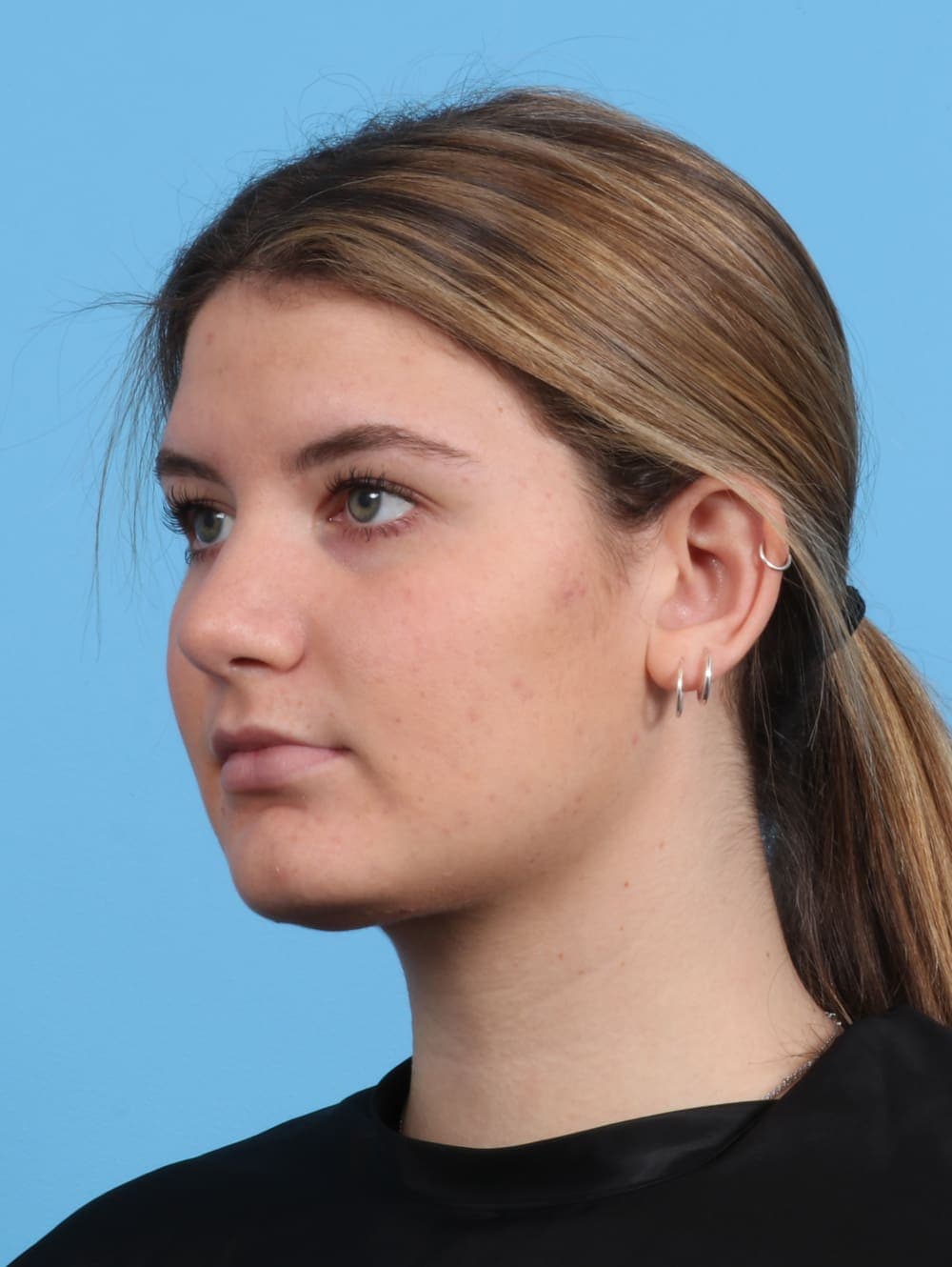 Rhinoplasty case #3145 after, image 3