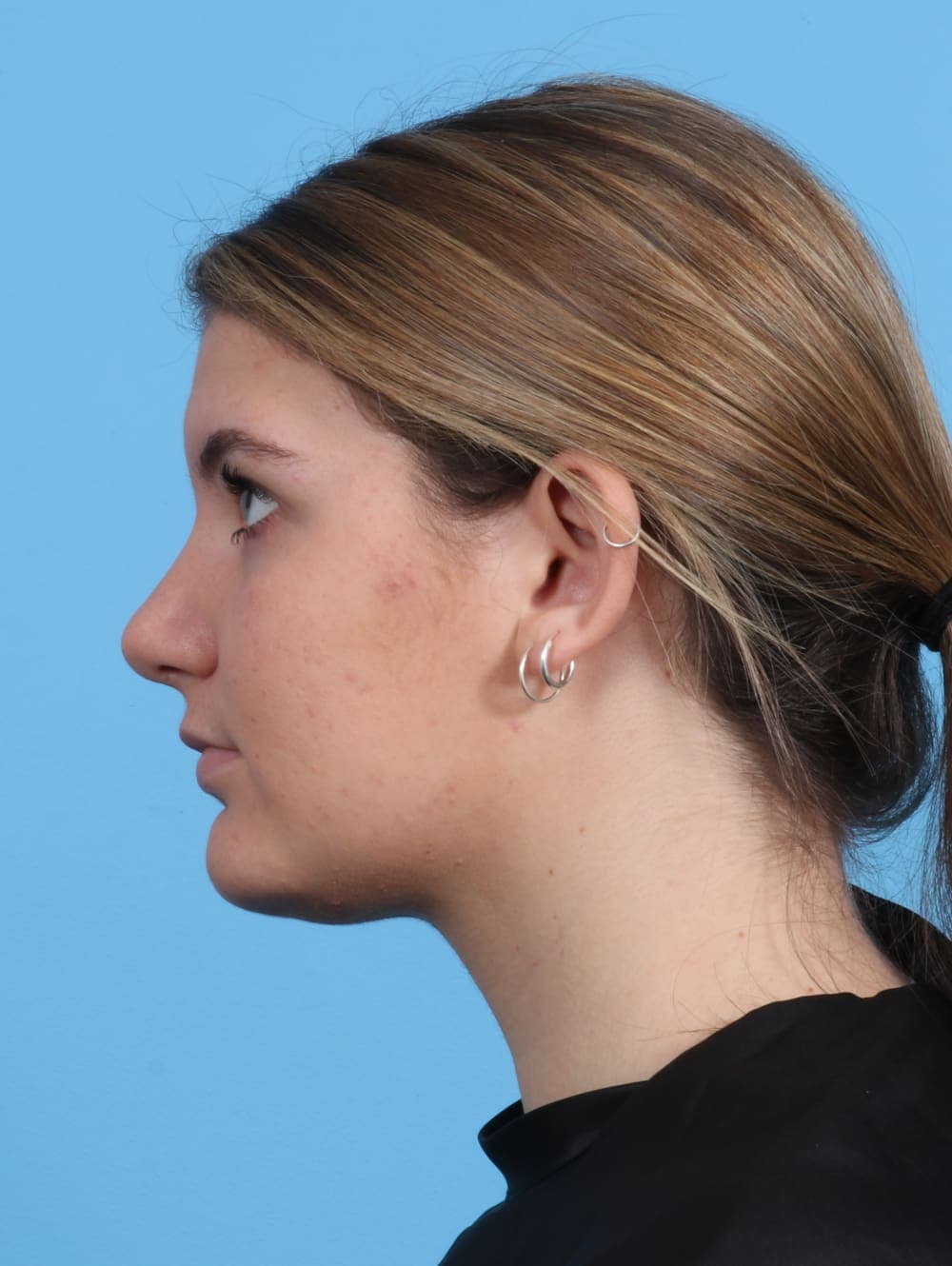 Rhinoplasty case #3145 after, image 1