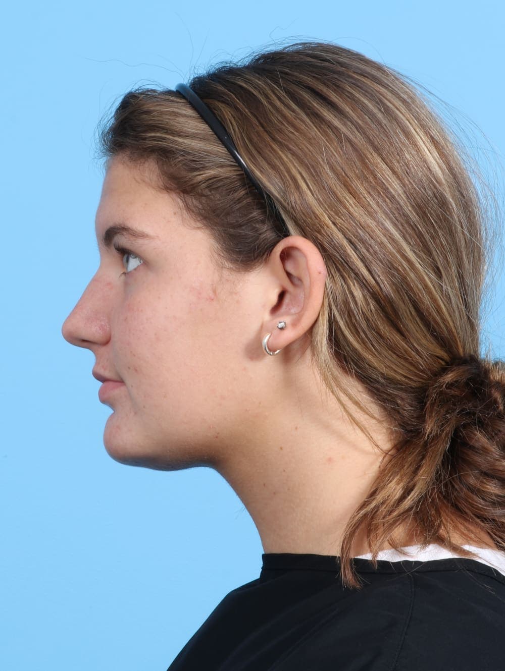 Rhinoplasty case #3145 before, image 1