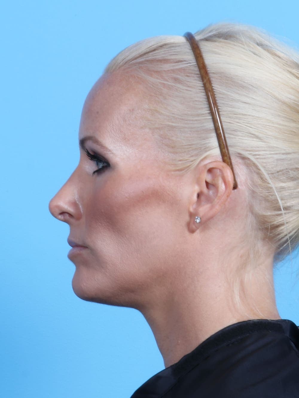 Rhinoplasty case #2655 after
