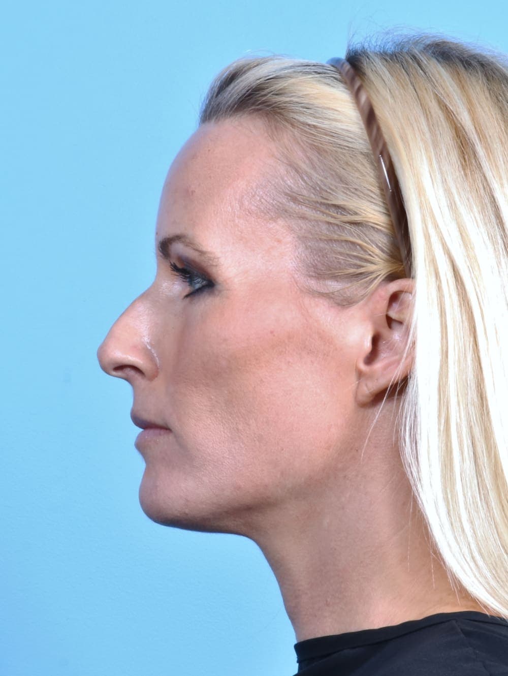 Rhinoplasty case #2655 before