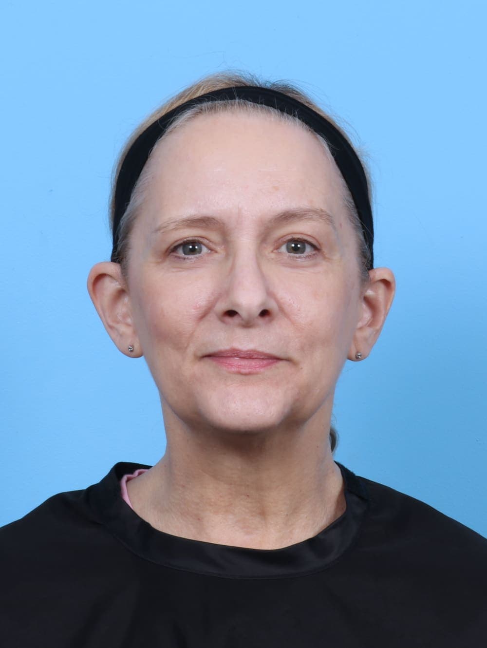 Eyelid Surgery case #5797 after