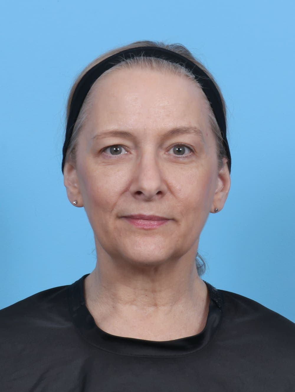 Eyelid Surgery case #5797 before