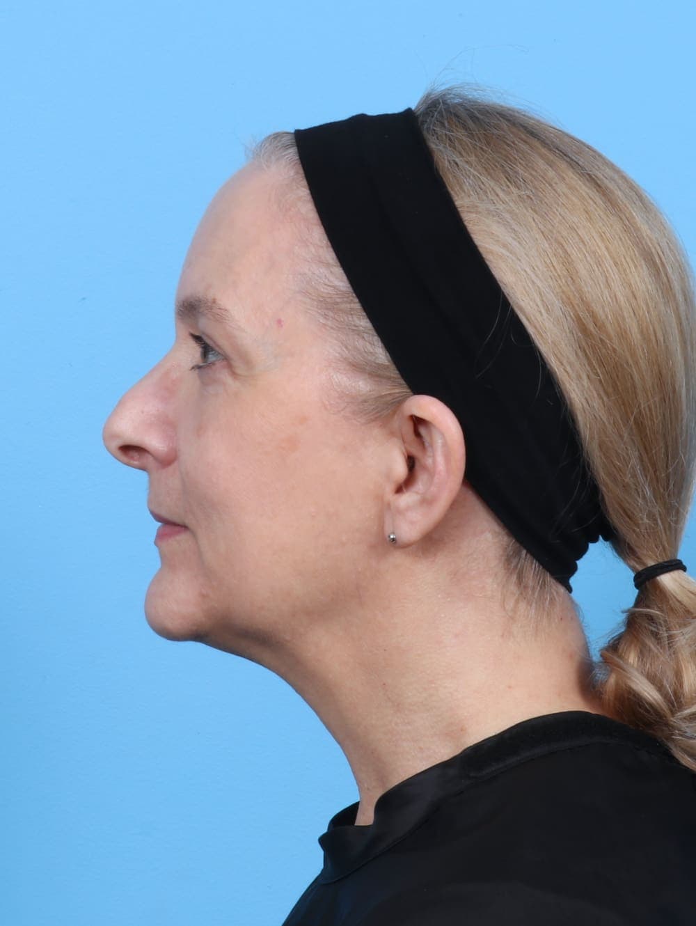 Eyelid Surgery case #5797 after, image 3