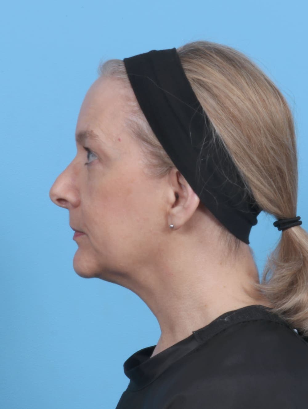 Eyelid Surgery case #5797 before, image 3