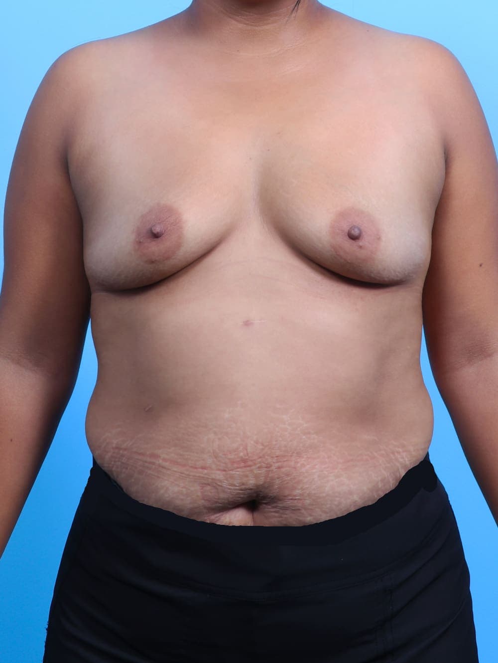 Breast Augmentation case #3112 before, image 1