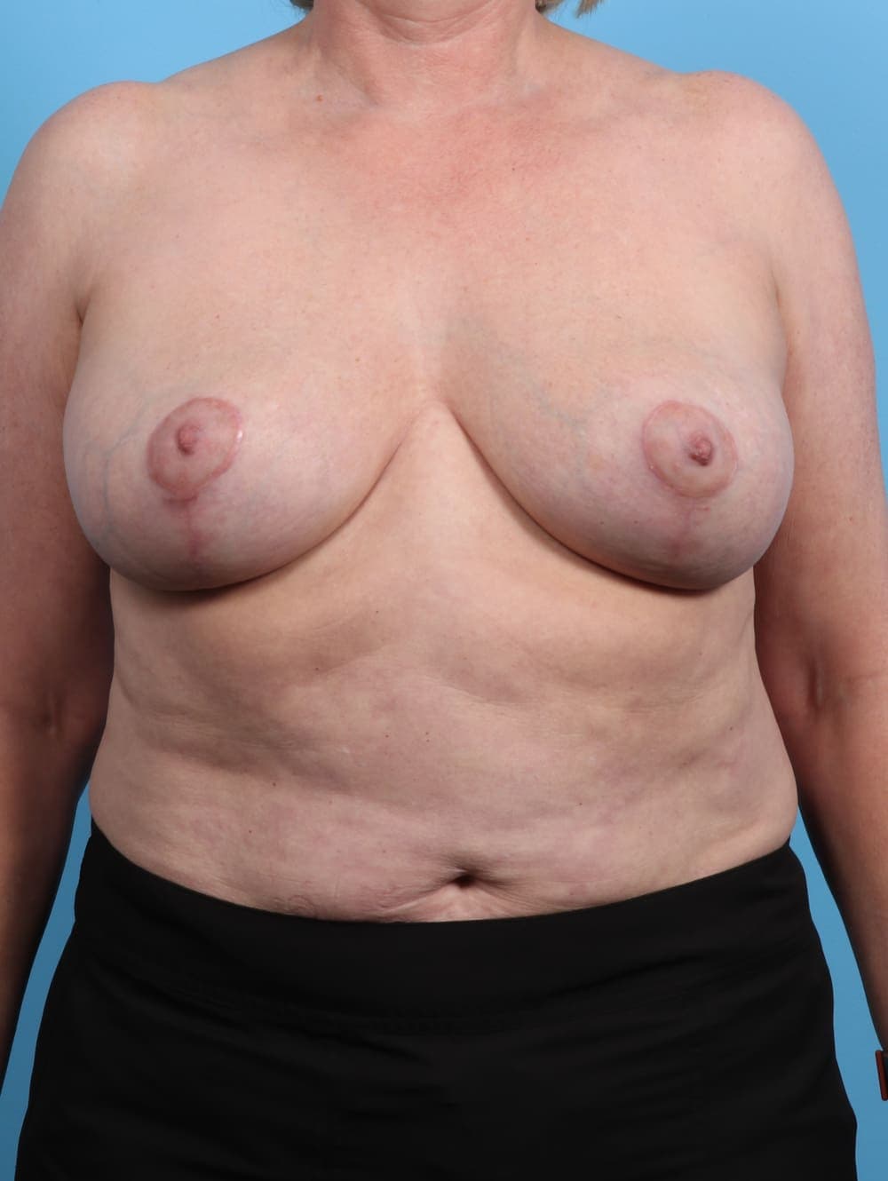 Breast Lift/Reduction case #3594 after