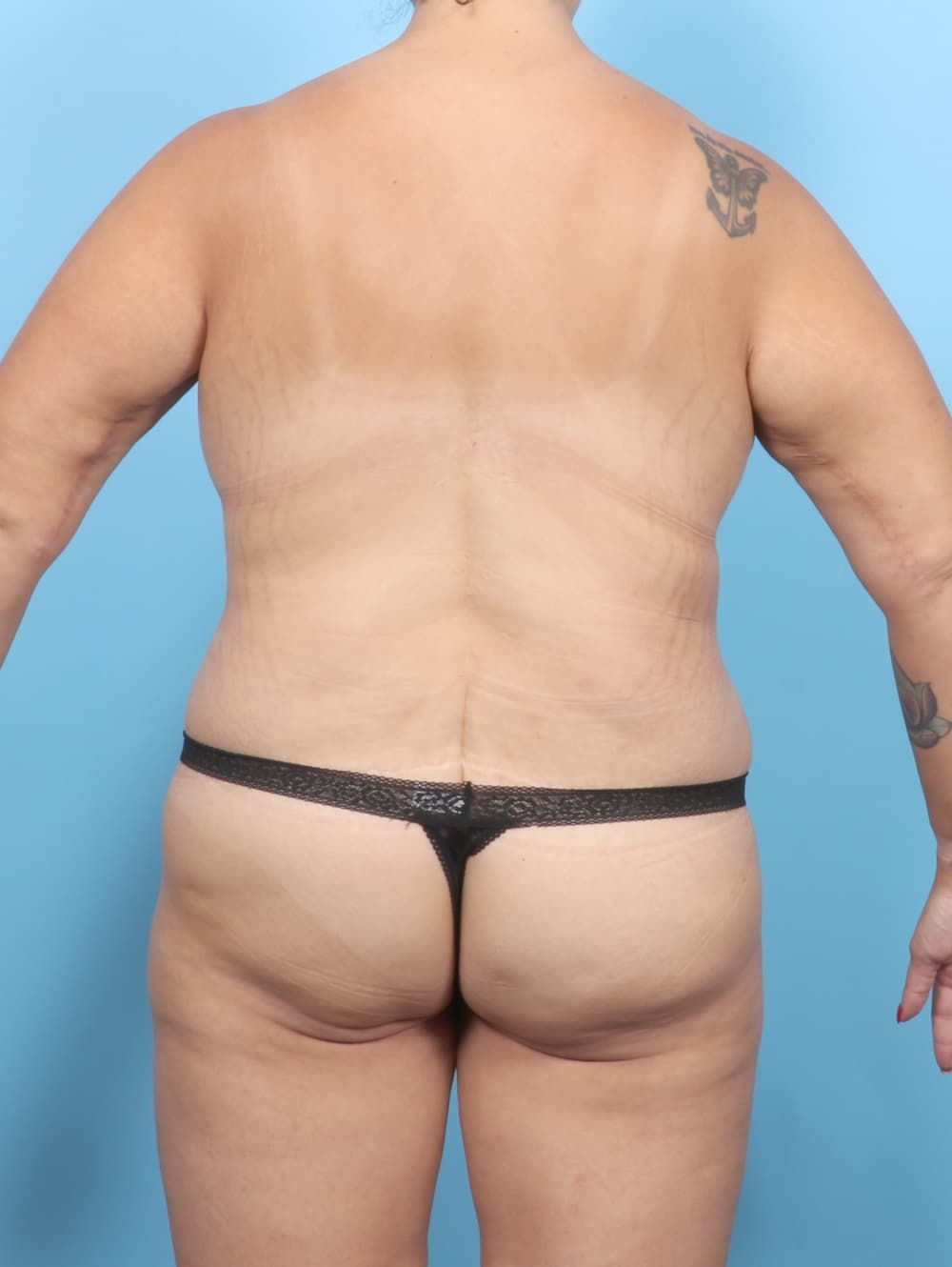 Breast Augmentation case #7078 after, image 4
