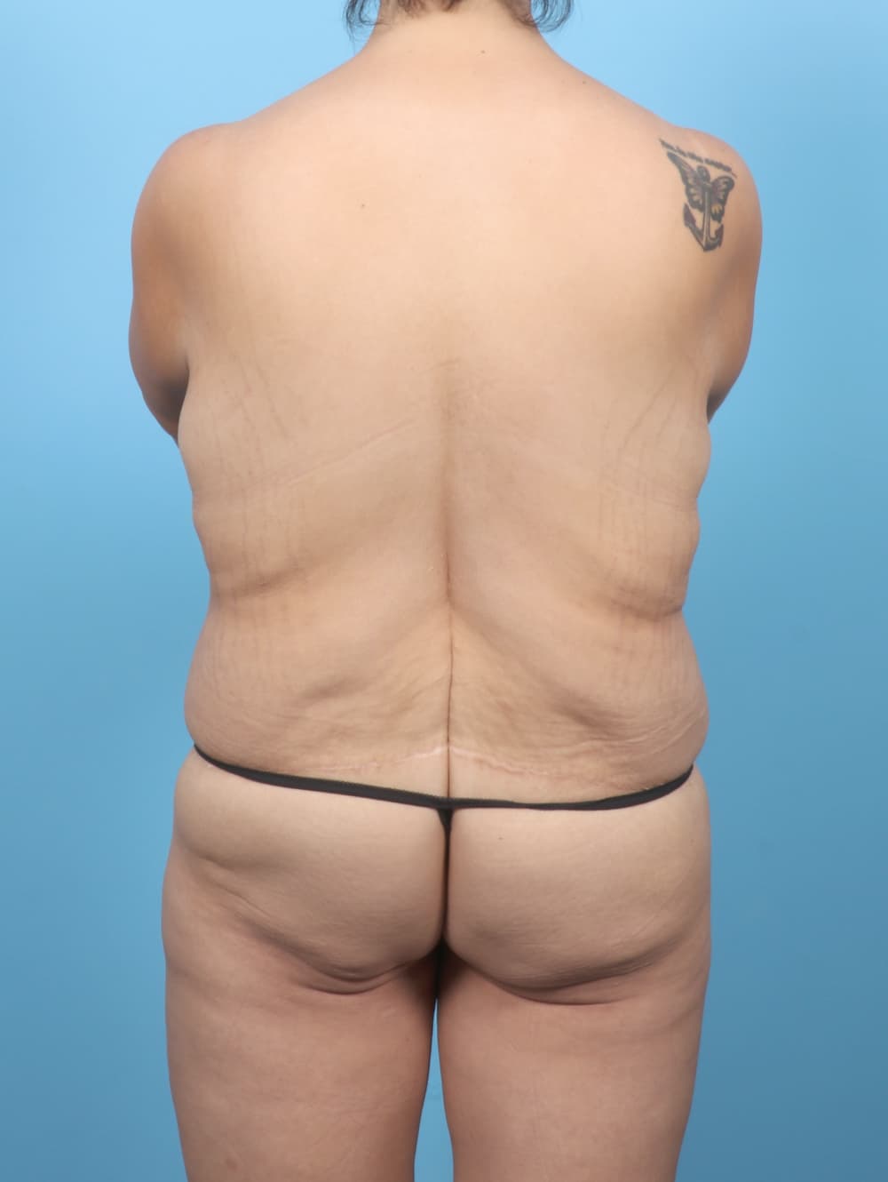 Breast Augmentation case #7078 before, image 4