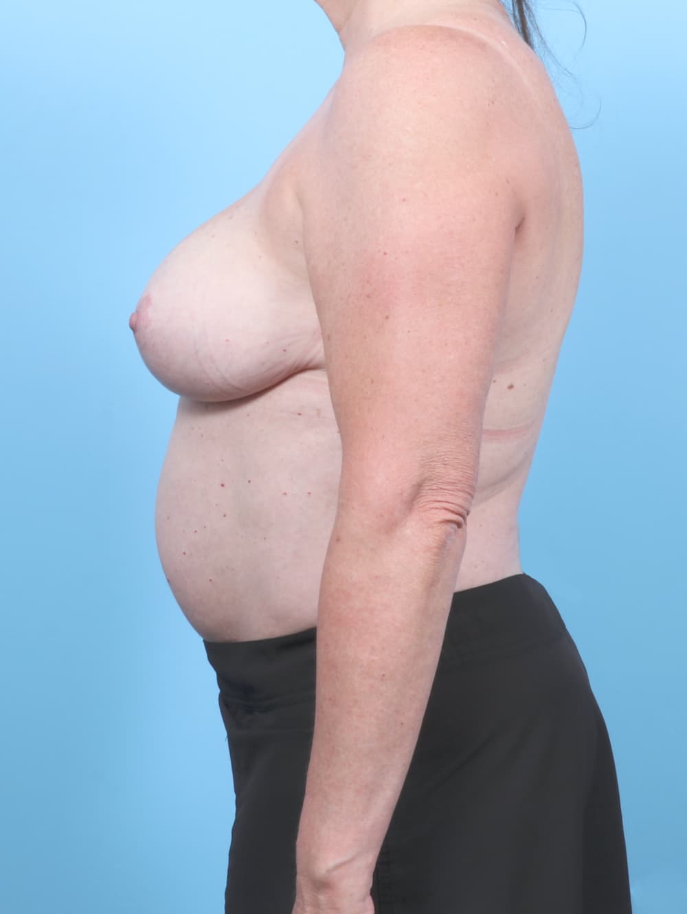 Breast Lift with Implants case #7046 after, image 3