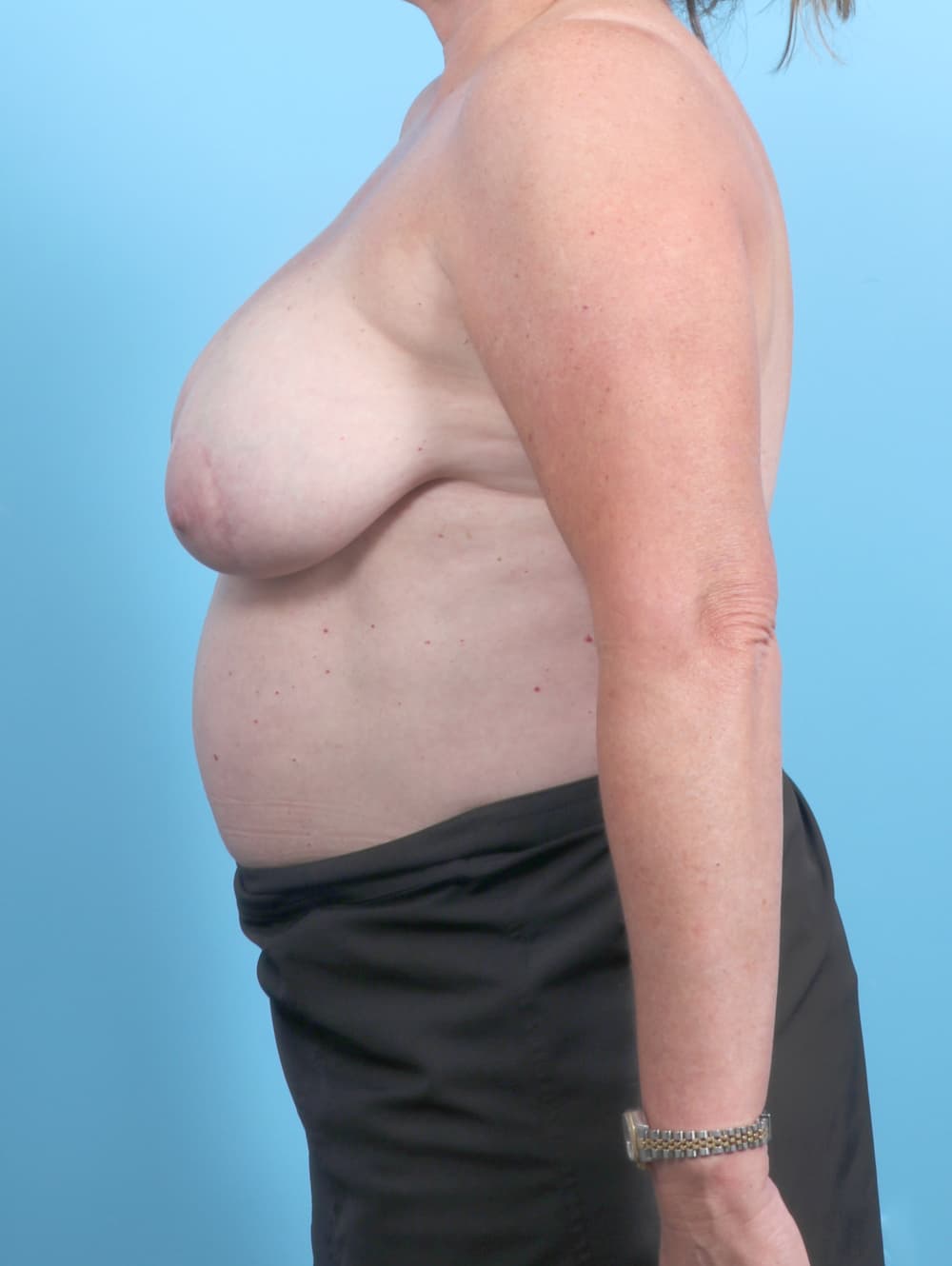 Breast Lift with Implants case #7046 before, image 3