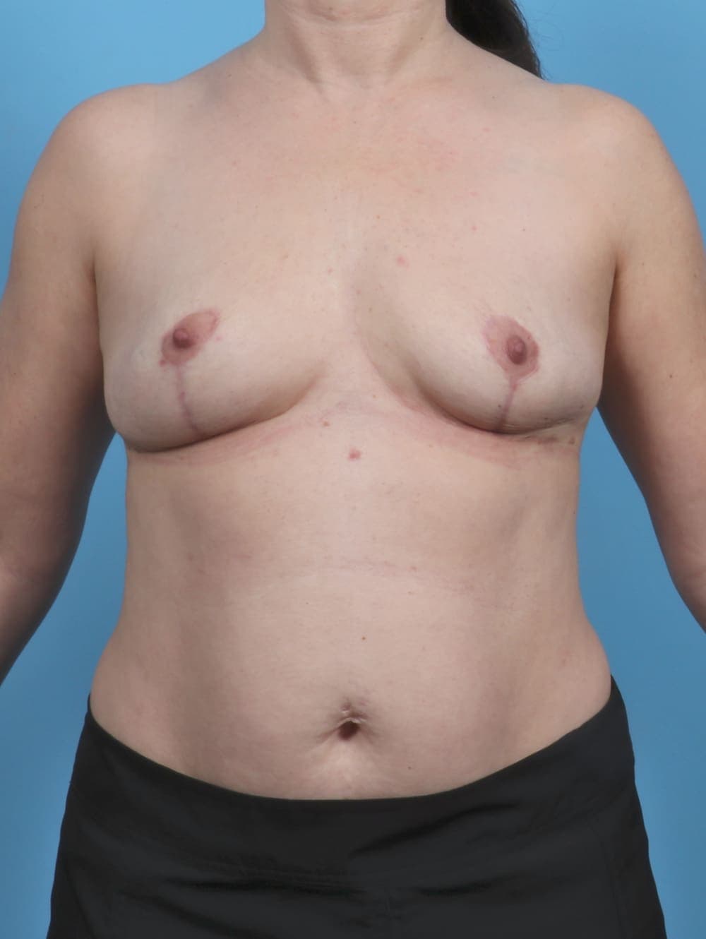 Breast Lift/Reduction case #5084 after