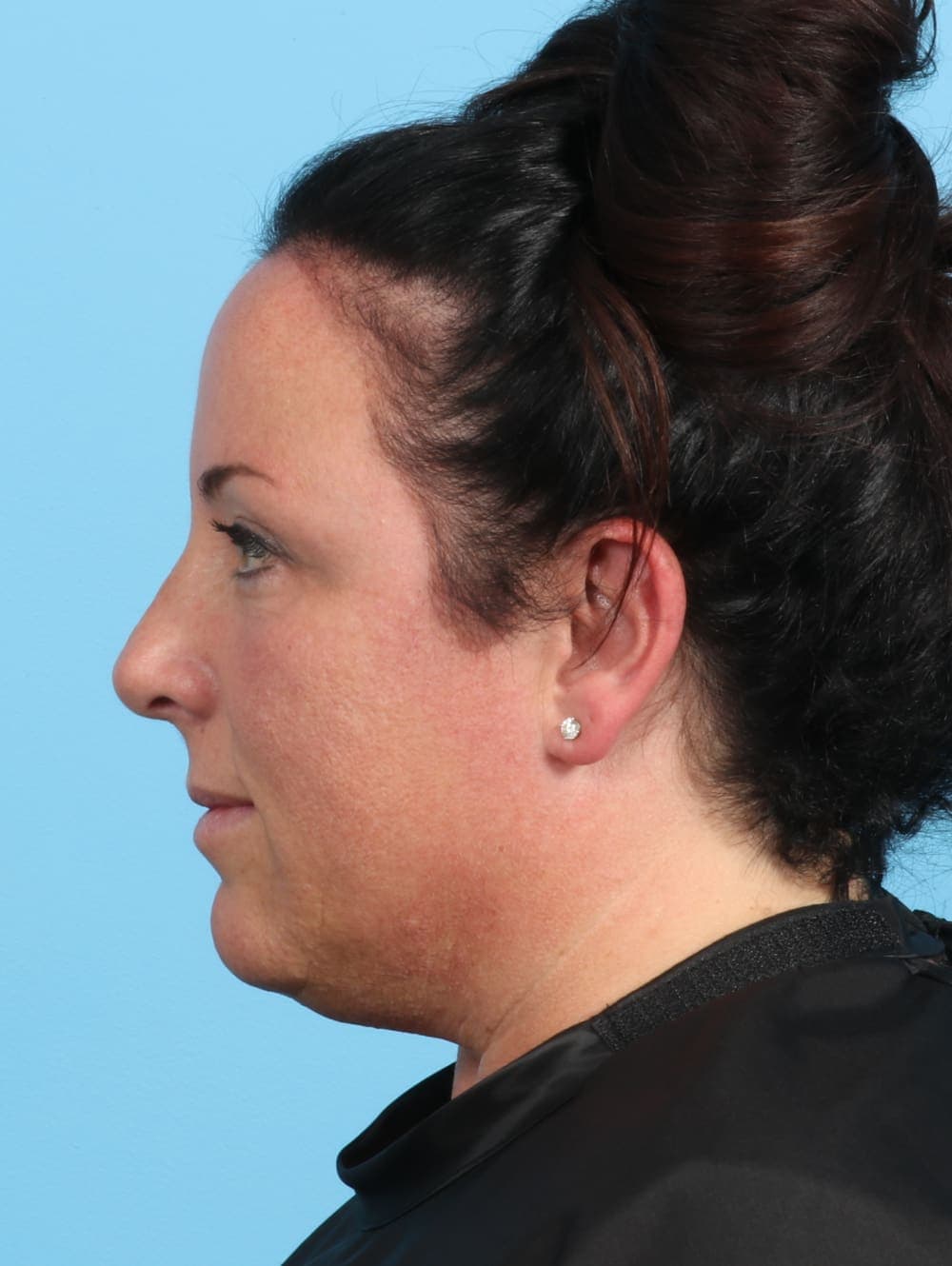 Rhinoplasty case #2671 after
