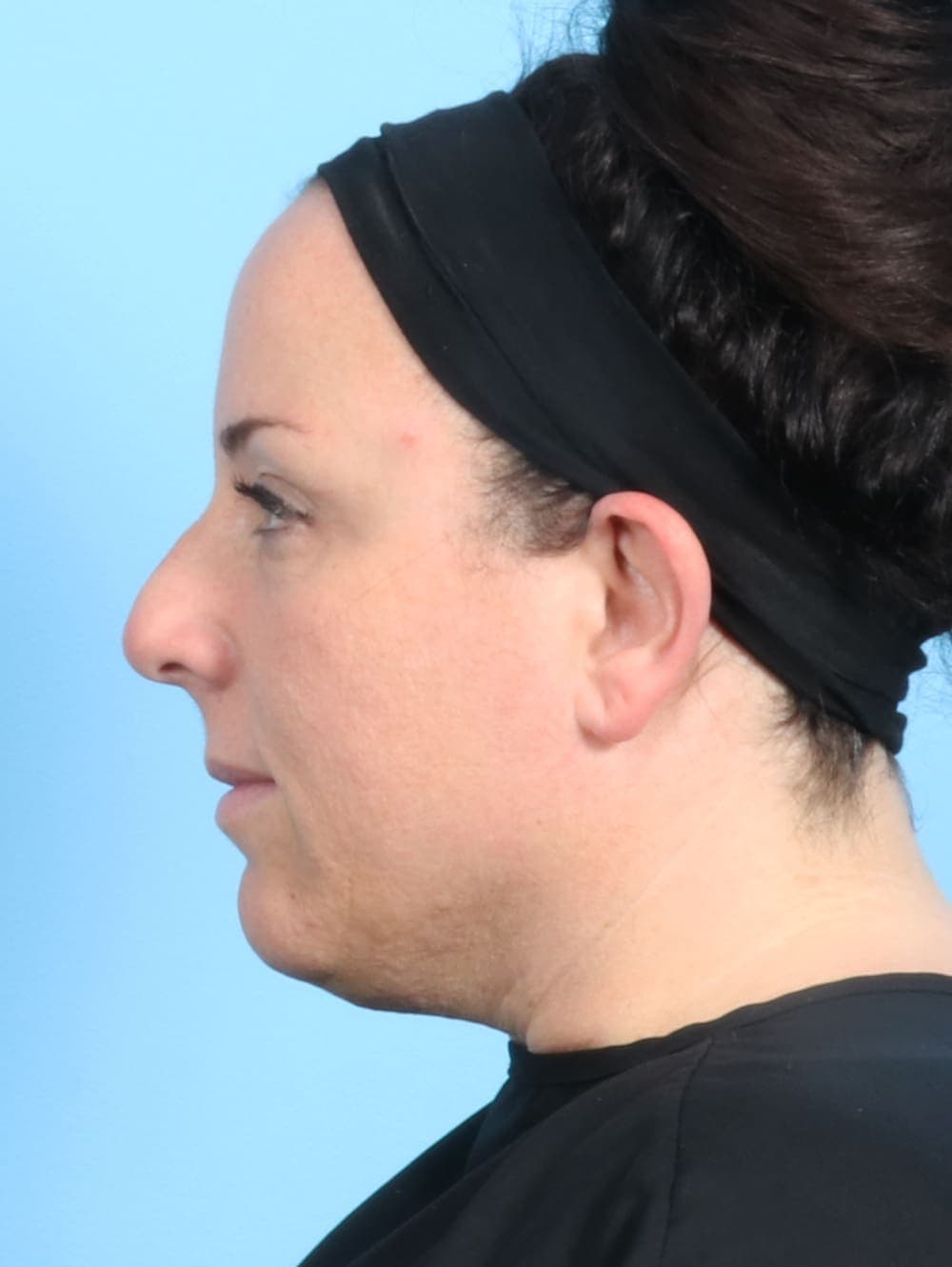 Rhinoplasty case #2671 before