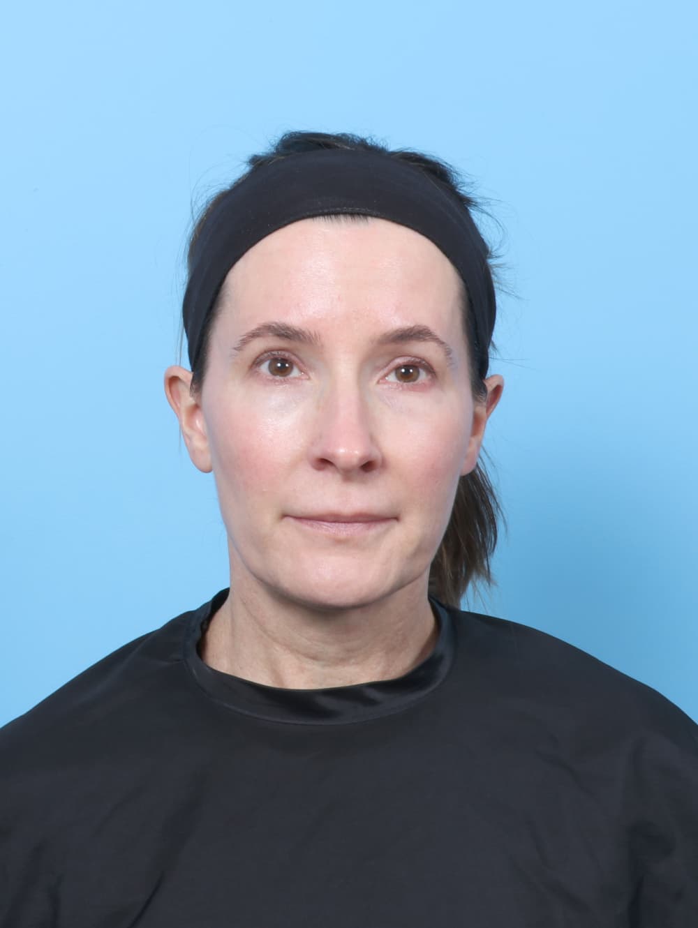 Eyelid Surgery case #8792 before, image 1