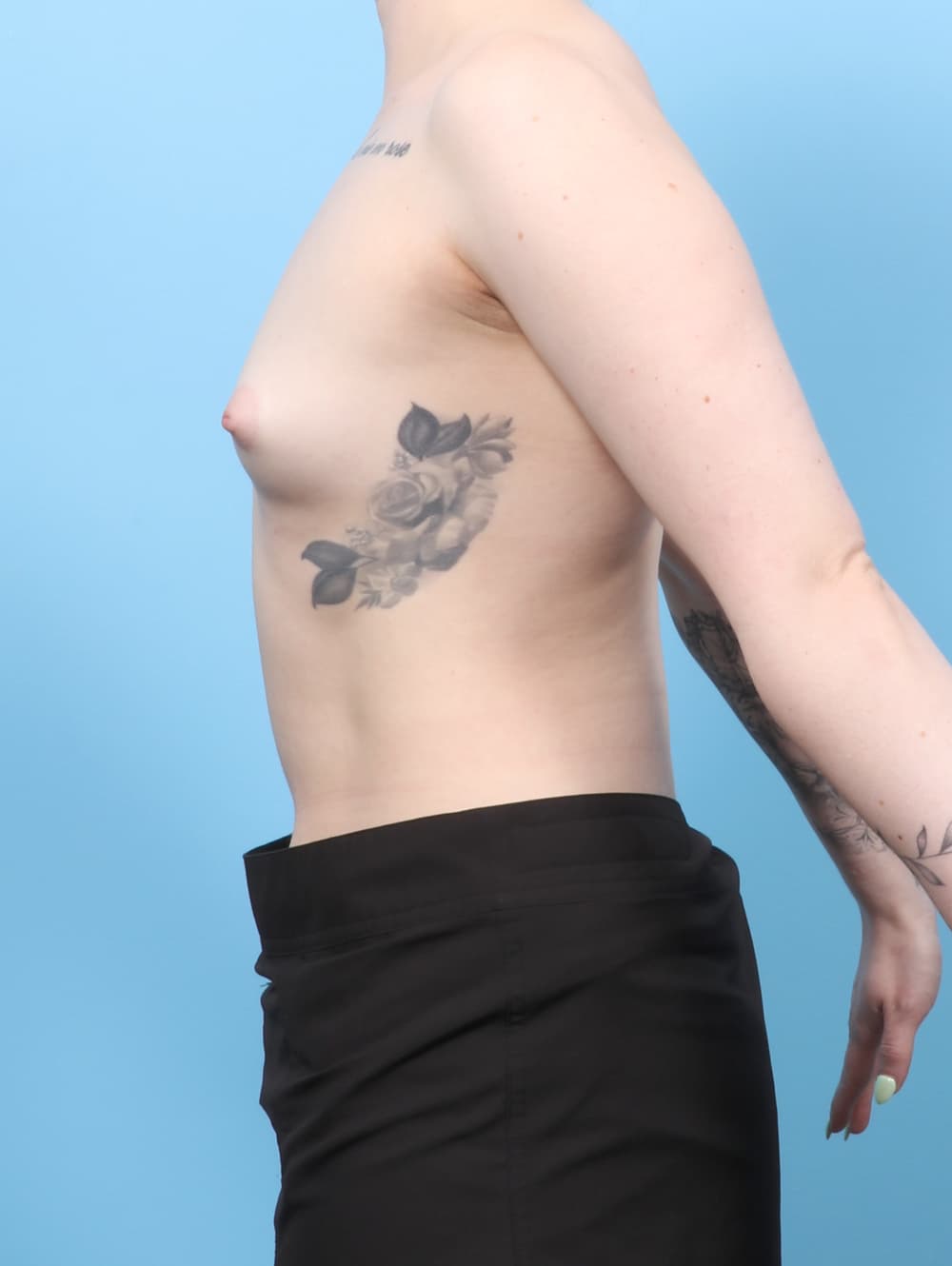 Breast Augmentation case #8409 before, image 3